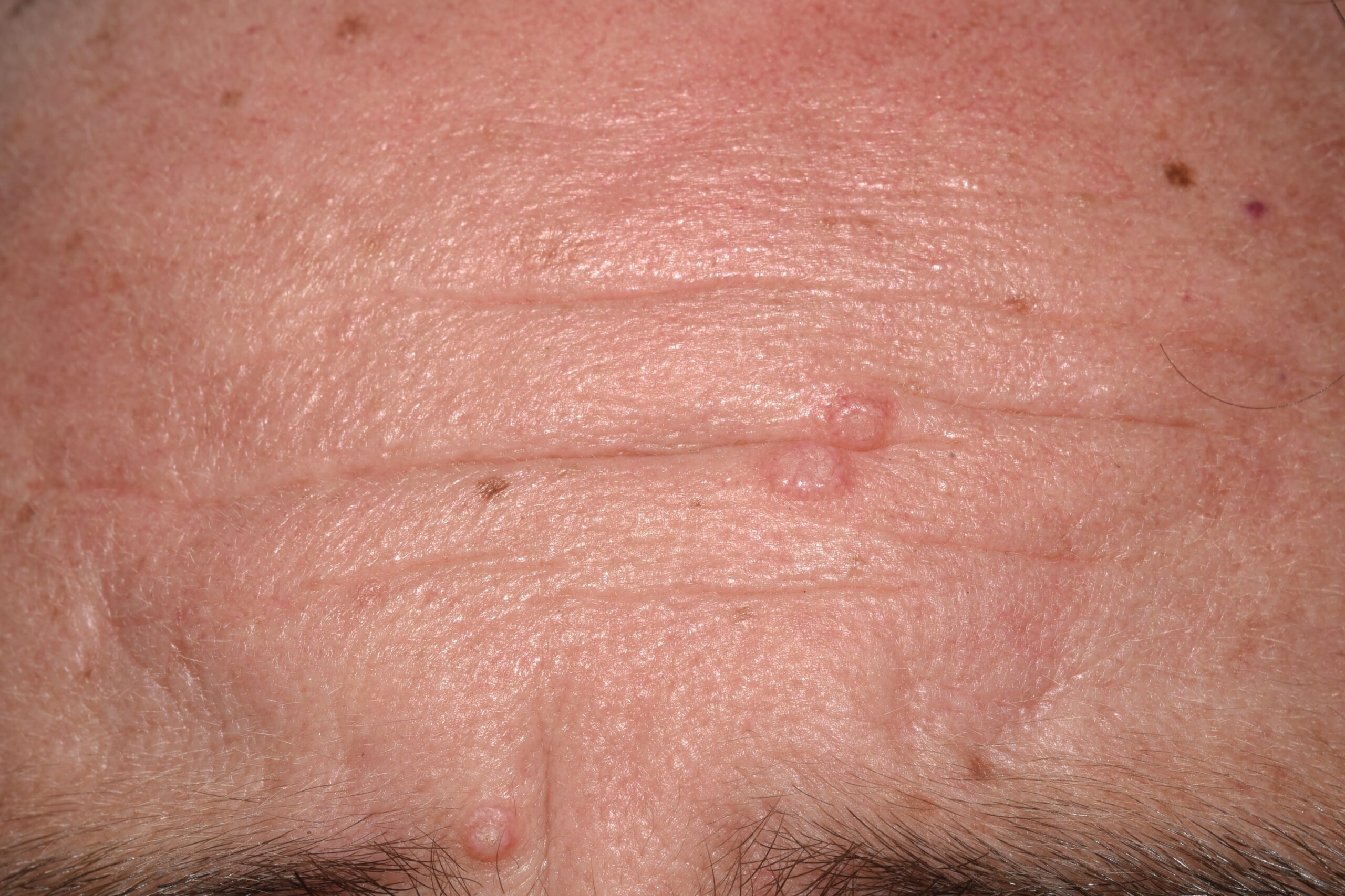 Molluscum contagiosum B08.1; pequeñas pápulas lisas de color normal de la piell localizadas en la frente de un paciente con sida