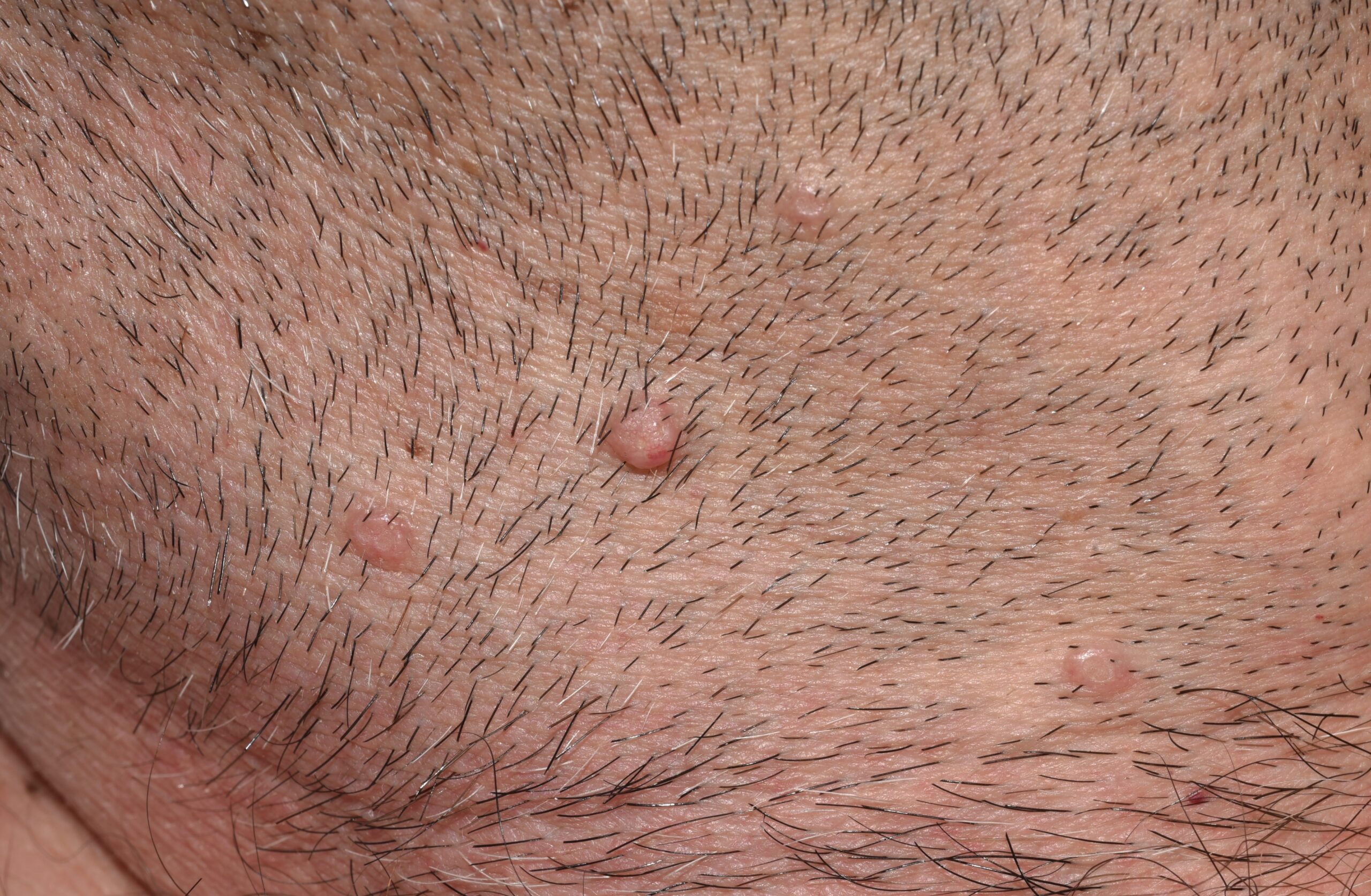 Molluscum contagiosum B08.1; pequeñas pápulas lisas de color normal de la piell localizadas en la barba de un paciente con sida1 (1)