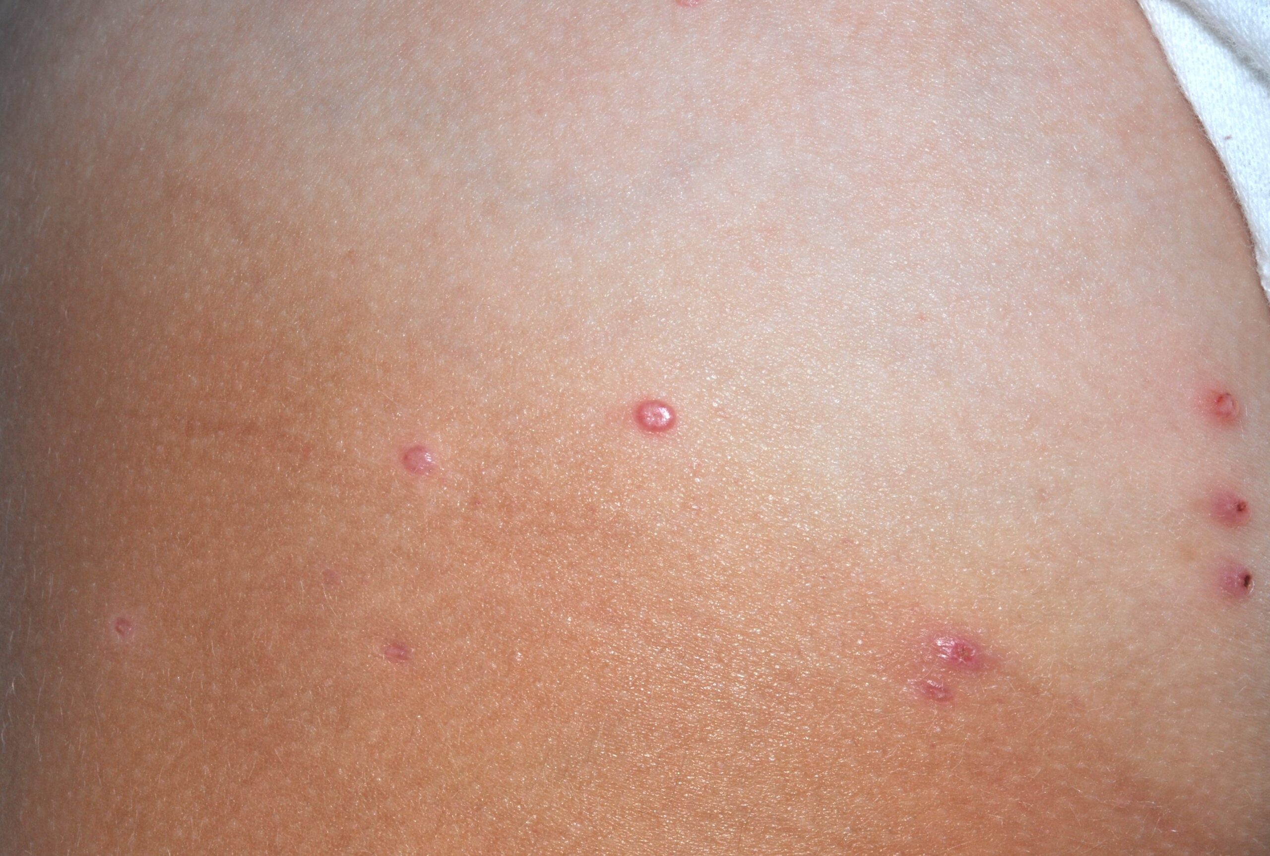 B08.1 molluscum contagiosum; pápulas lisas del color normal de la piel con umbilicación central; localización raiz del muslo