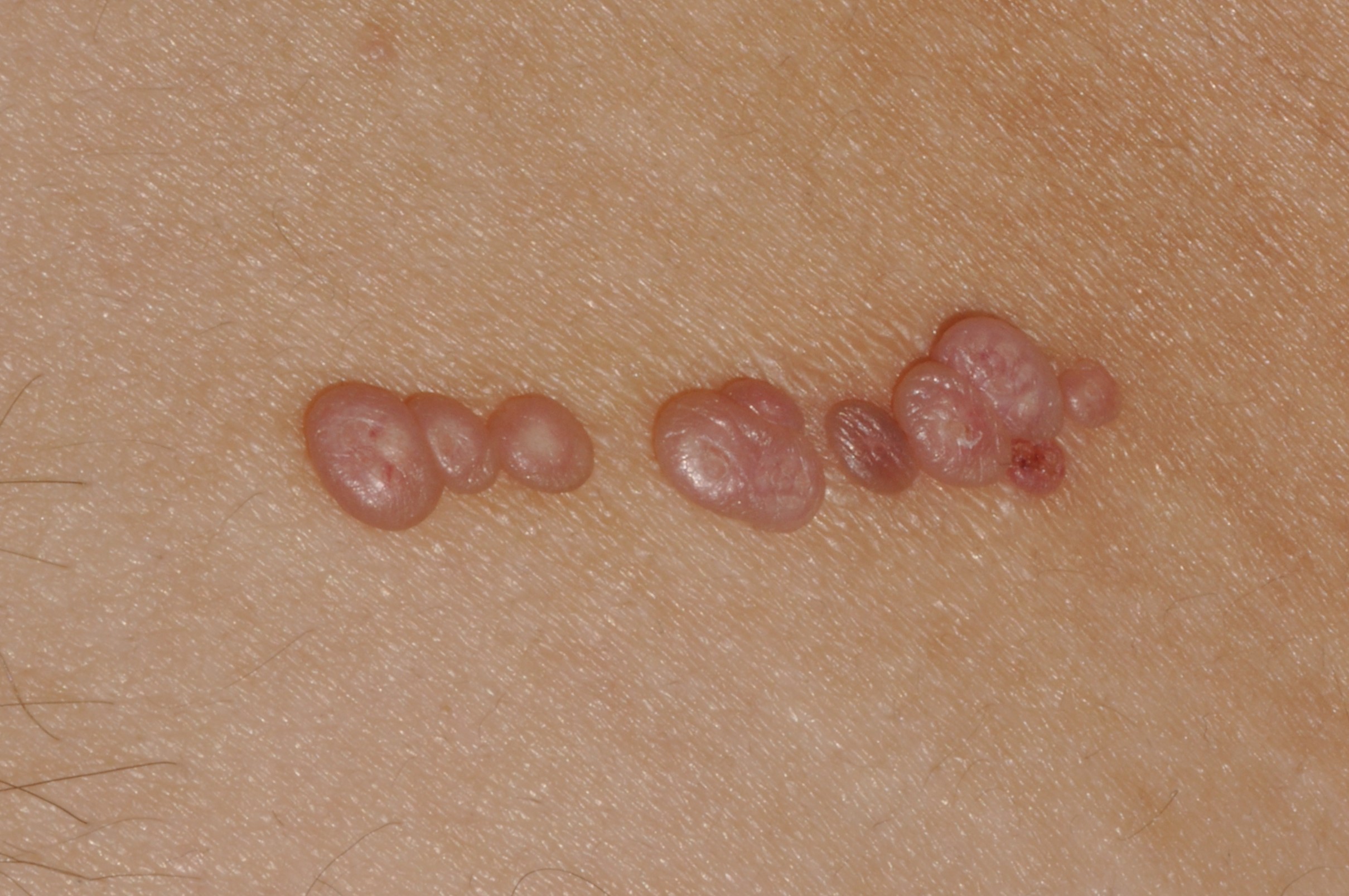 Molluscum contagiosum B08.1; pápulas lisas de color rosado con umbilicación central; fenómeno de Koebner, disposición lineal; localización tronco