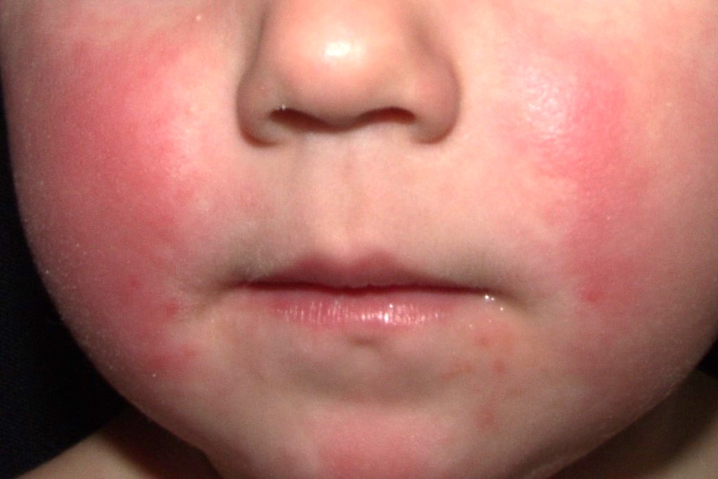 eritema infeccioso B08.3; infeccion por parvovirus B19; eritema malar, cara abofeteada (5)