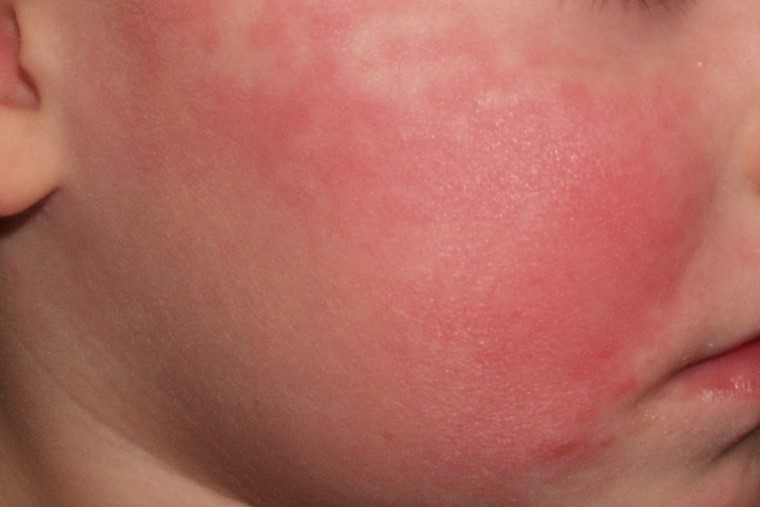 eritema infeccioso B08.3; infeccion por parvovirus B19; eritema malar, cara abofeteada (2)