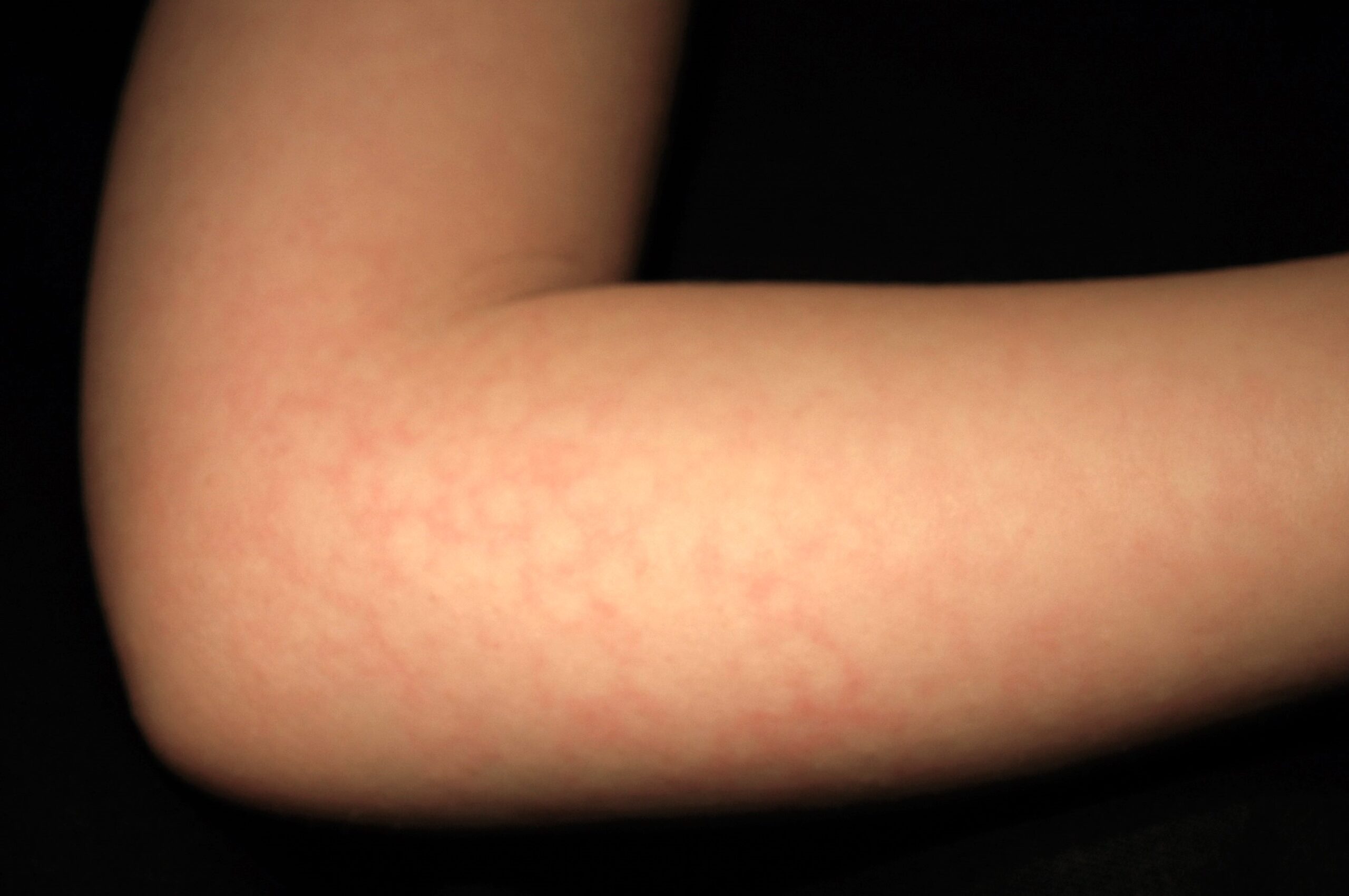 eritema infeccioso B08.3; infeccion por parvovirus B19; eritema reticulado en brazos (1)