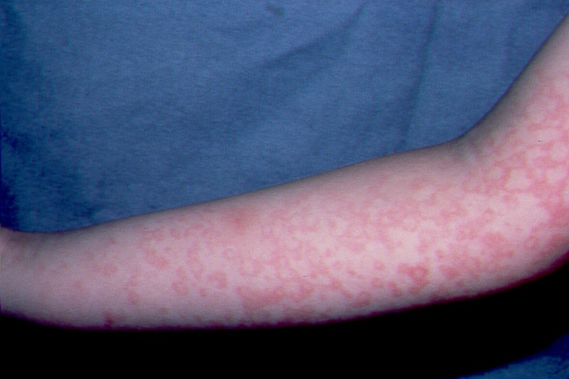 eritema infeccioso B08.3; infeccion por parvovirus B19; eritema reticulado en brazos (10)