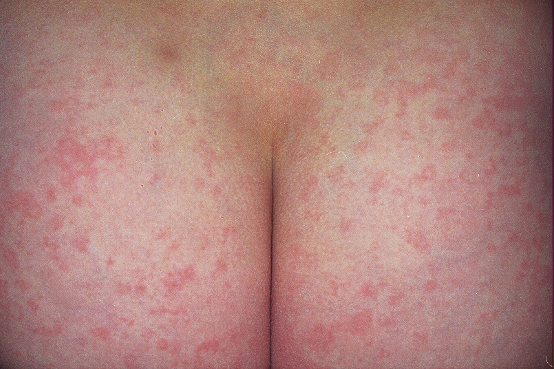eritema infeccioso B08.3; infeccion por parvovirus B19; eritema reticulado en nalgas