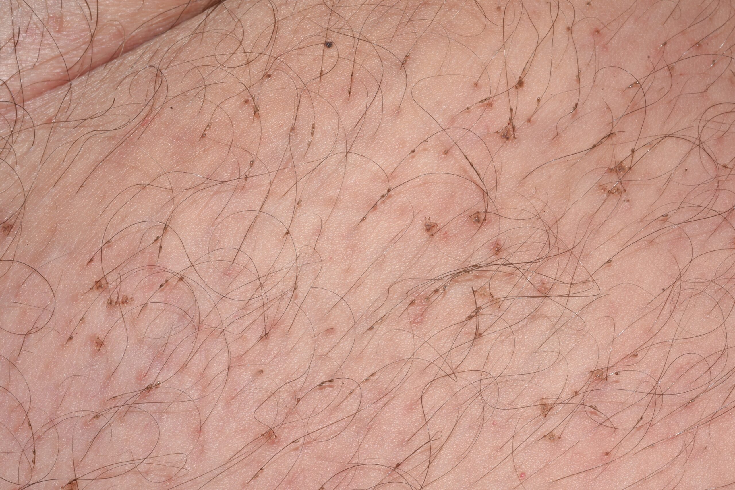 Pediculosis pubis B85.3; pthirus y liendres. Se aprecian  par&aacute;sitos triangulares adheridos al vello pubiano y sus liendres (1)