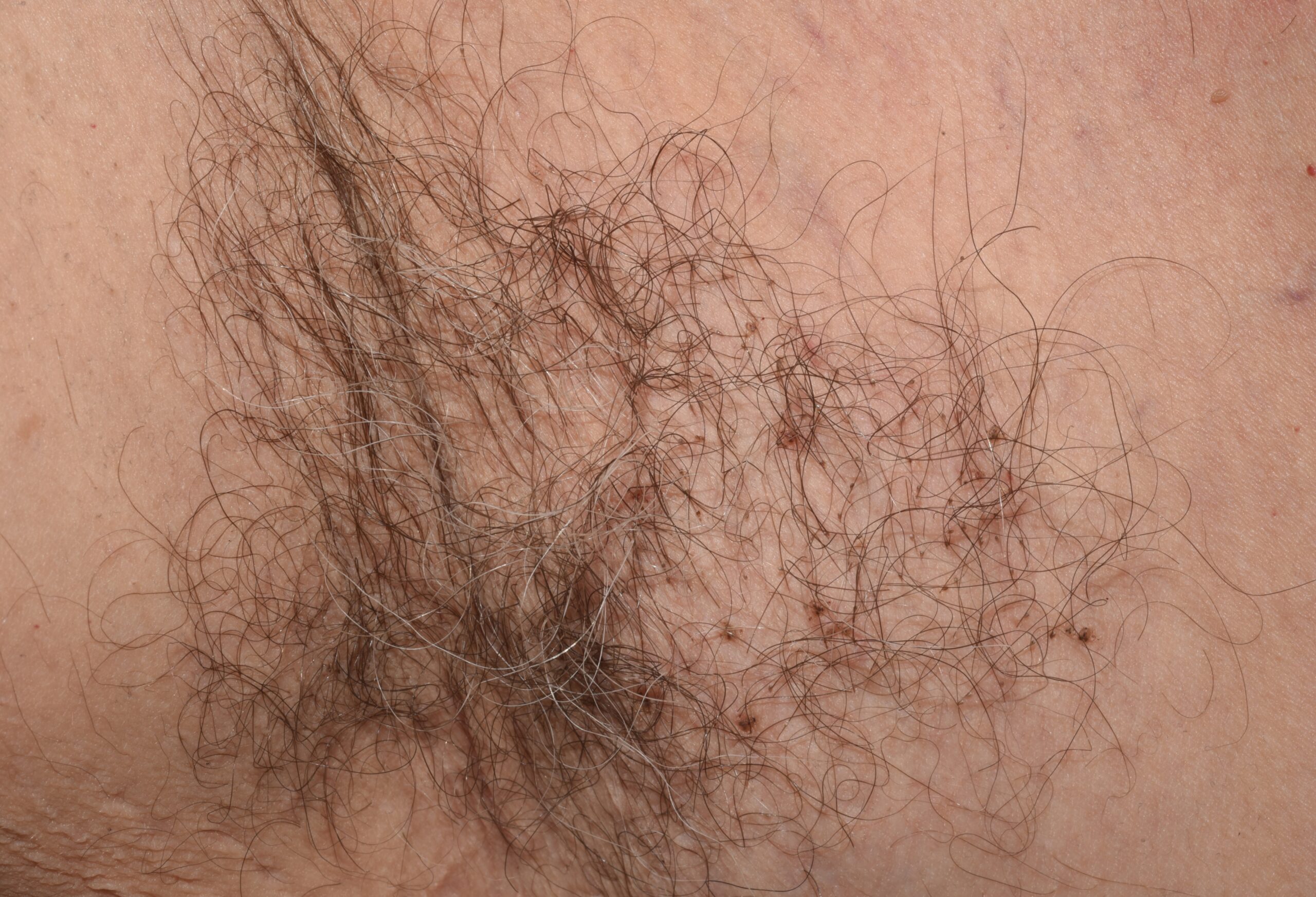 Pediculosis pubis B85.3; pthirus y liendres adheridos al vello axilar