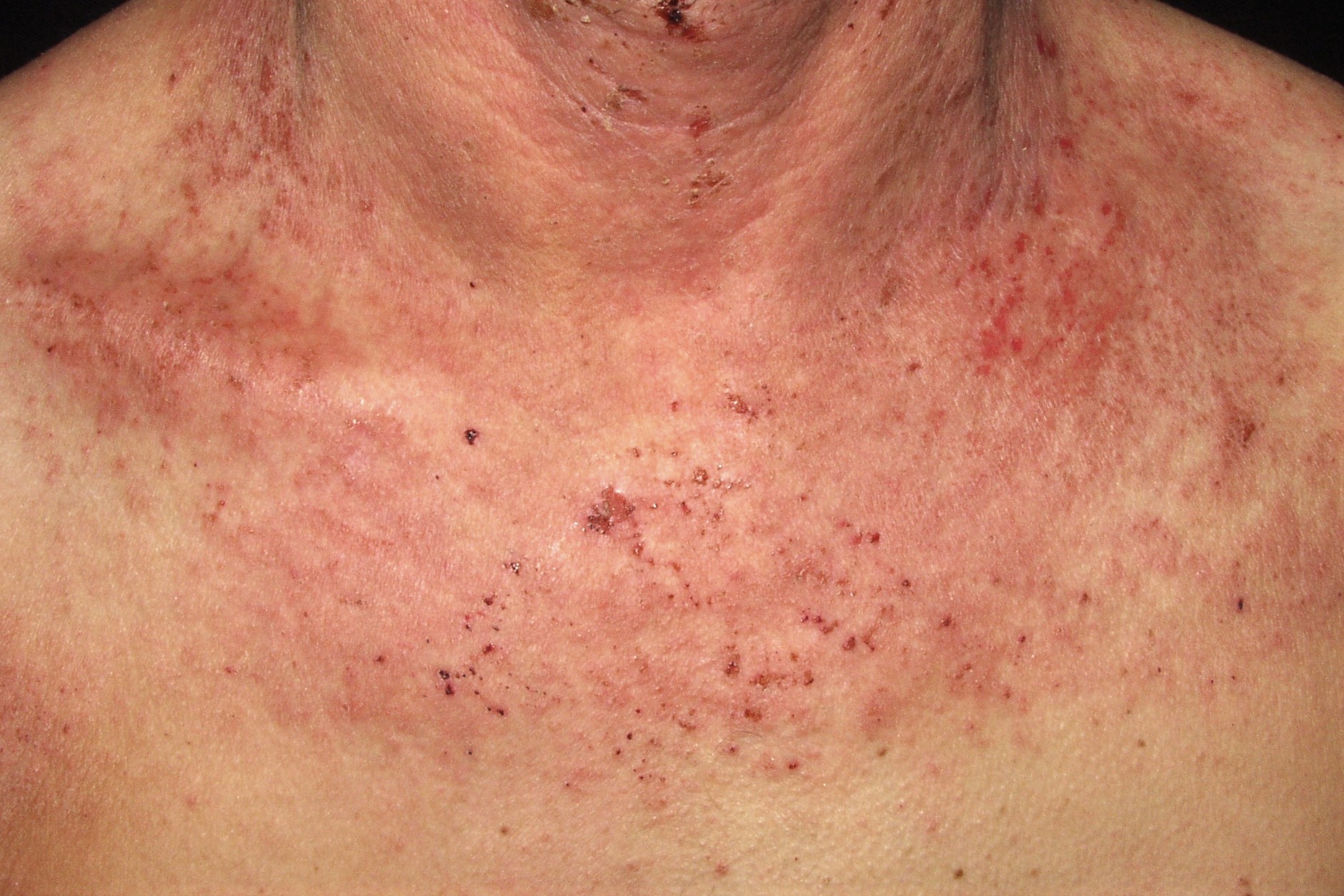 01L20 dermatitis atópica del adulto; placas eritematoexudativas y costrosas pliegue del cuello (1)