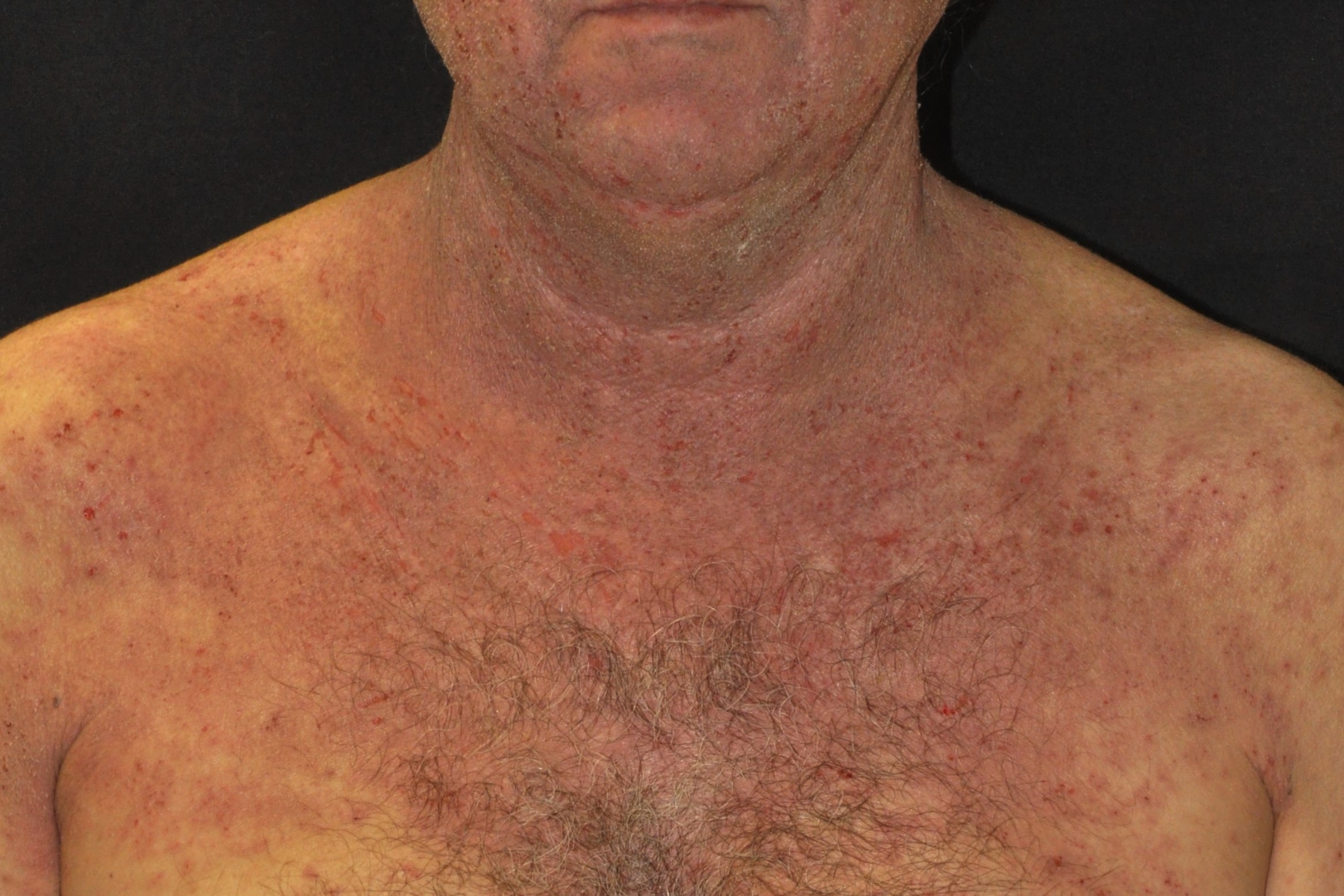 01L20 dermatitis atópica del adulto; placas eritematoexudativas y costrosas pliegue del cuello (2)