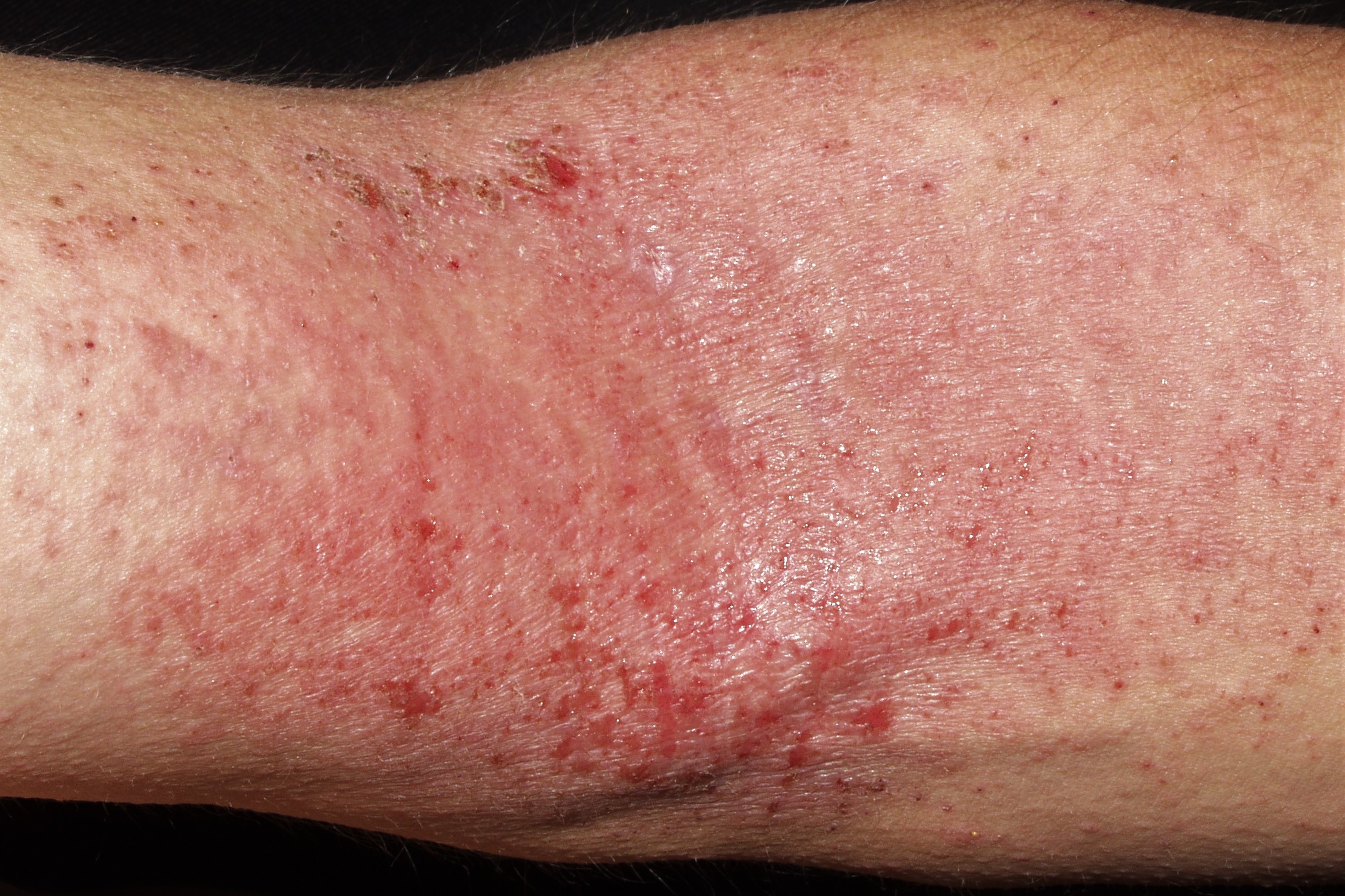 01L20 dermatitis atópica del adulto; placas eritematoexudativas y costrosas pliegue del cuello (3)