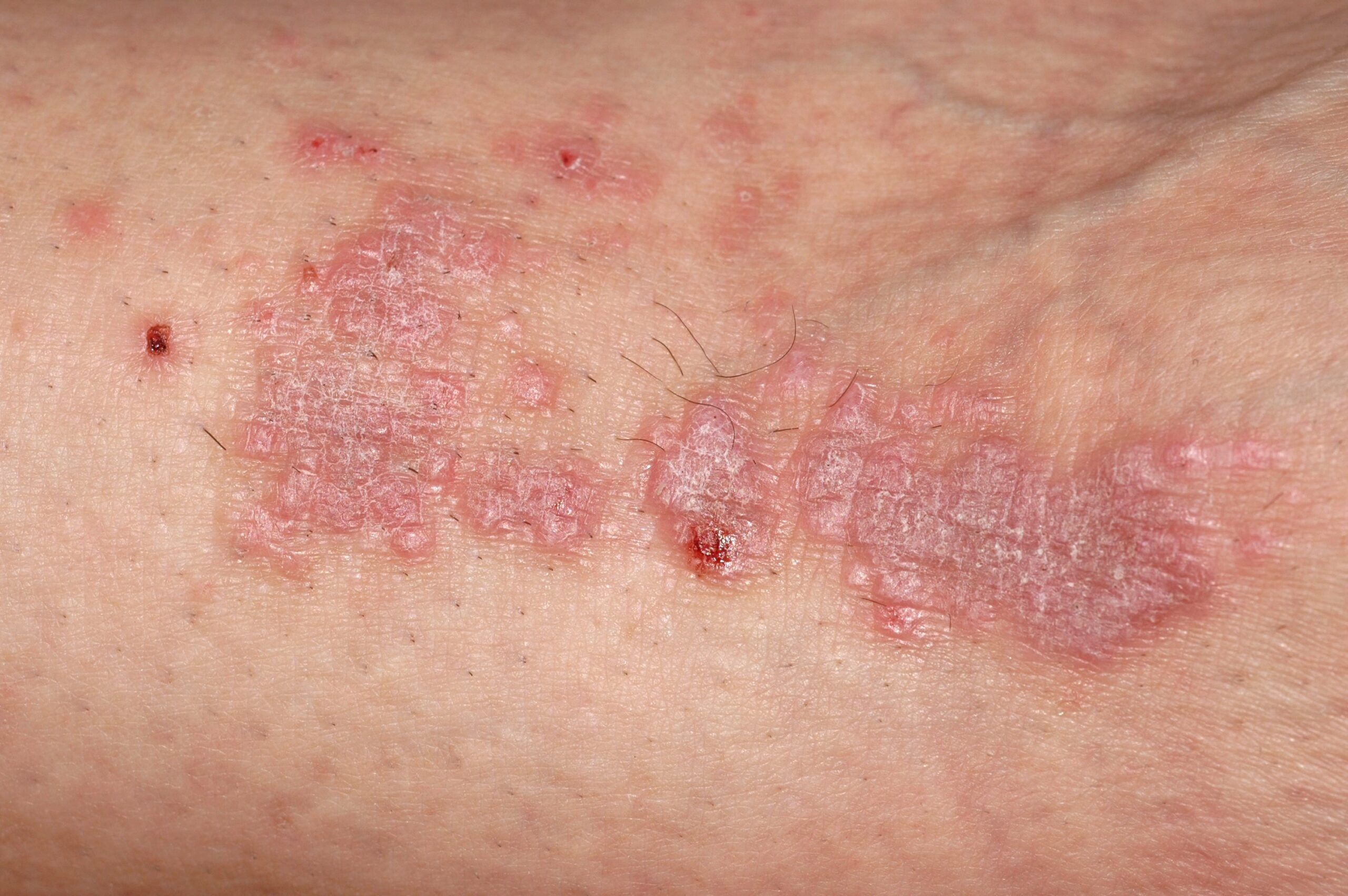 01neurodermitis dermatitis atopica  230805 (14)