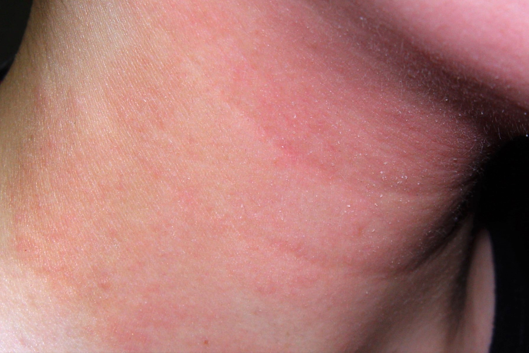 11L20 dermatitis atópica; fase del infantil; fase crónica; placas eritematosas, pruriginosas, liquenificadas y excoriadas en pliegue del cuello (1)