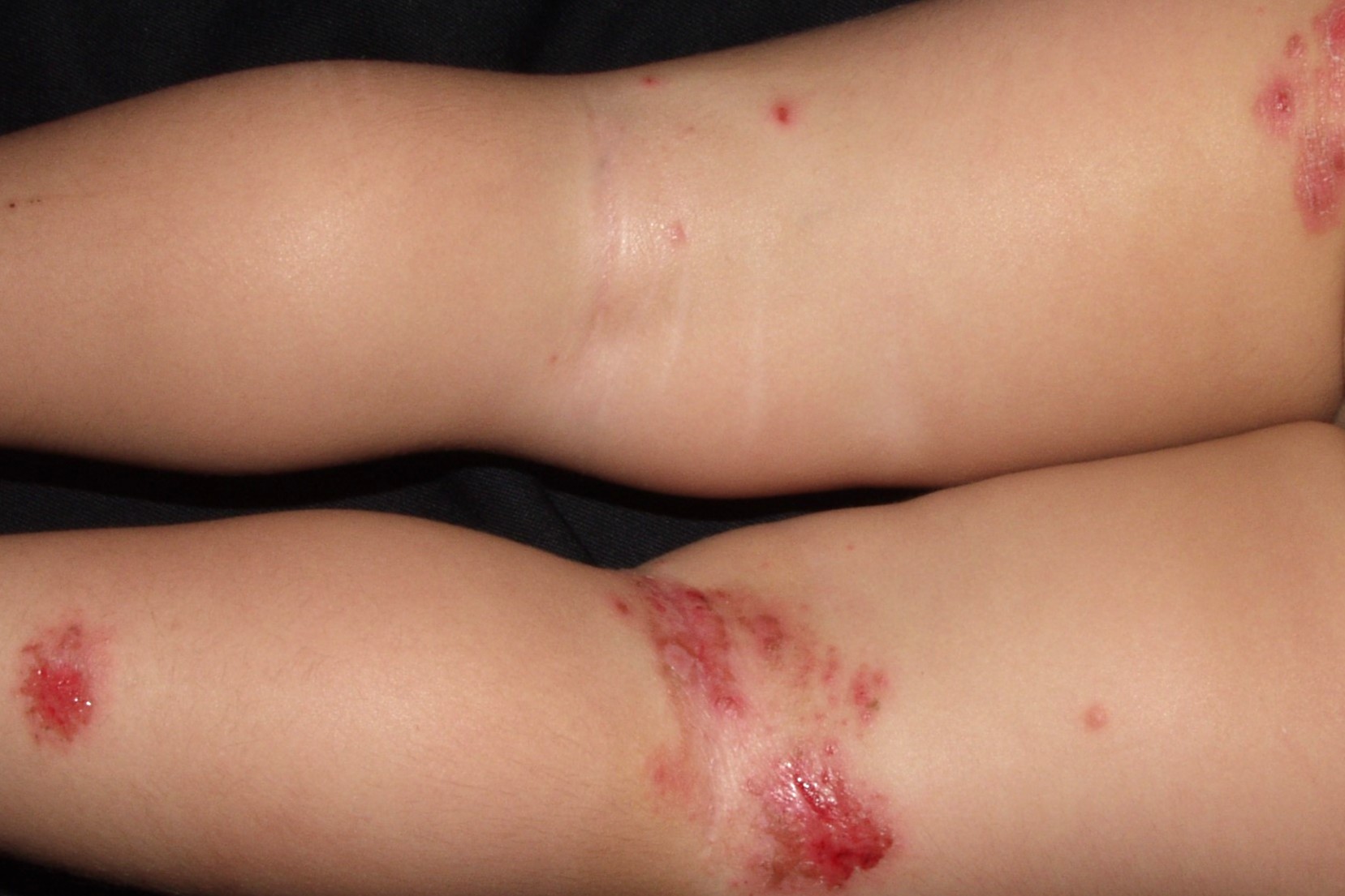 1L01.1 dermatitis atópica sobreinfectada; estafilococo; distribución pliegues; evolución días (1)