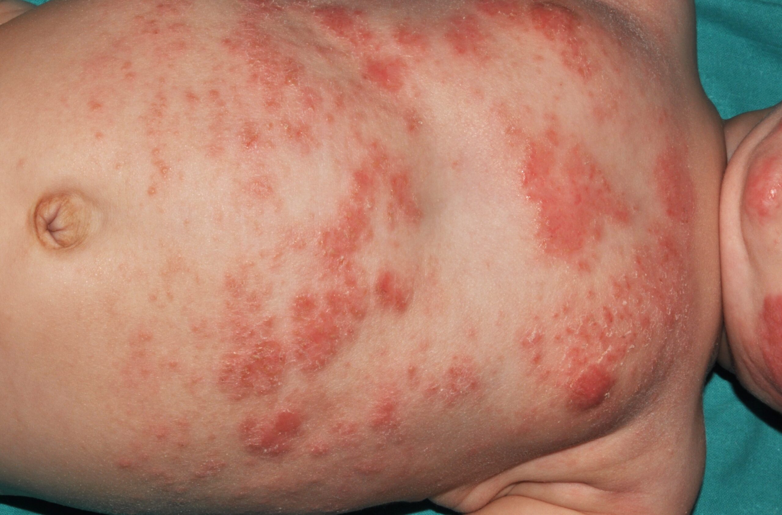 1L20 dermatitis atópica del lactante; placas eritematoexudativas y costrosas pliegue del cuello (2)