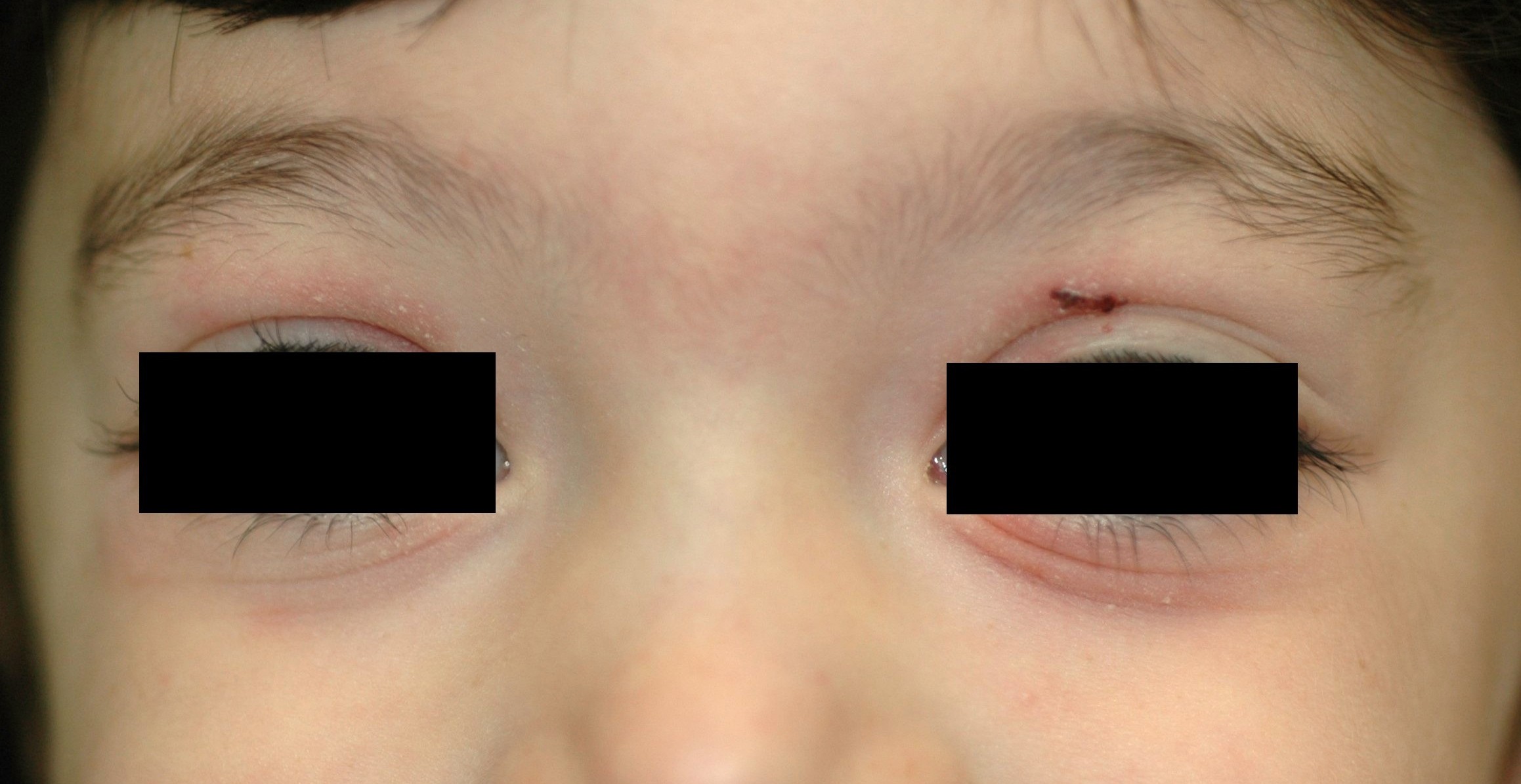 1L20 dermatitis atopica, eczema palpebral con doble pliegue (signo de edi morgan)1 (3)