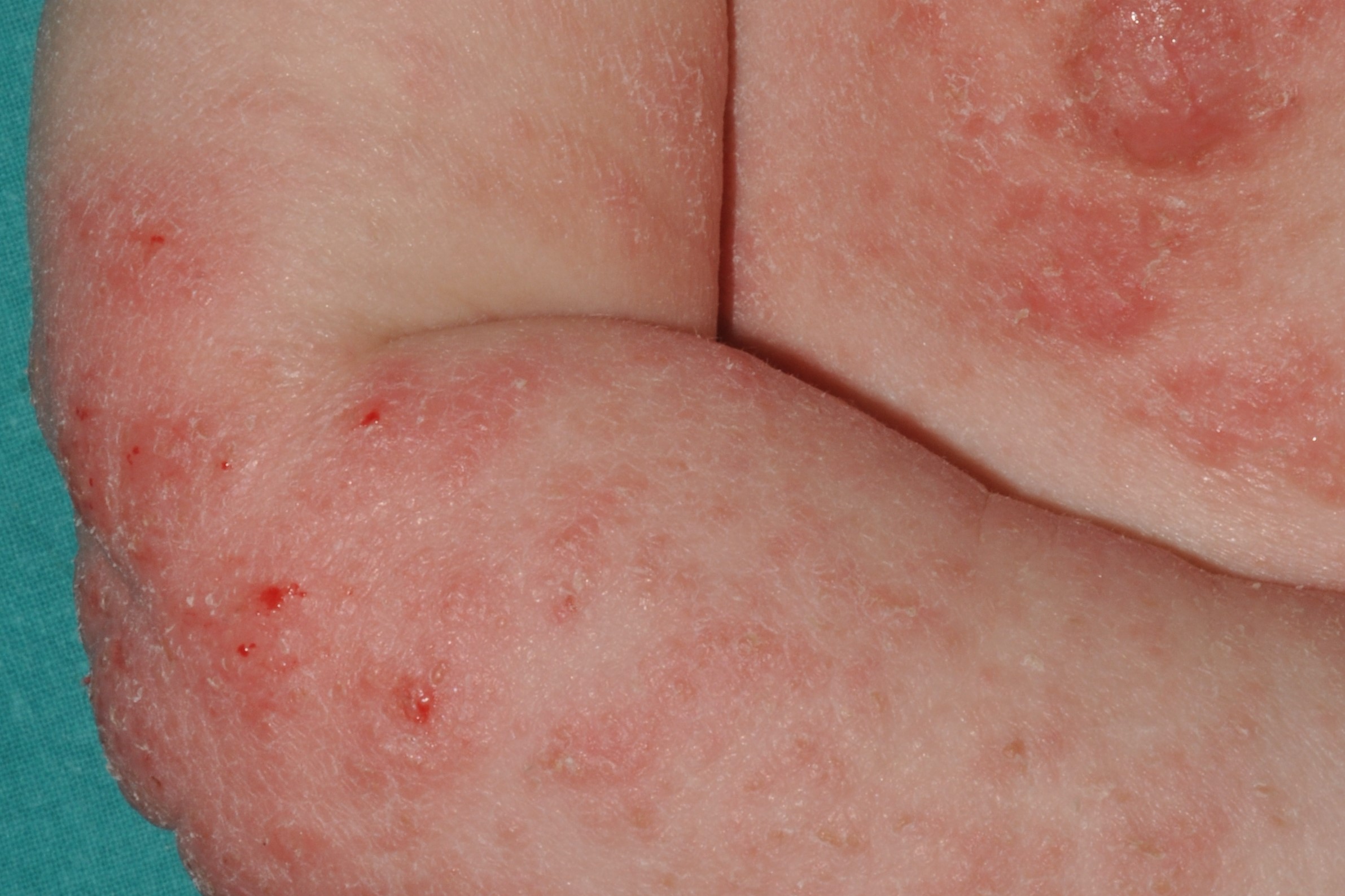 1L20 dermatitis atòpica; fase del lactante; eczema subagudo; placas eritematoexudativas y costrosas en  los brazos y el tronco (1)