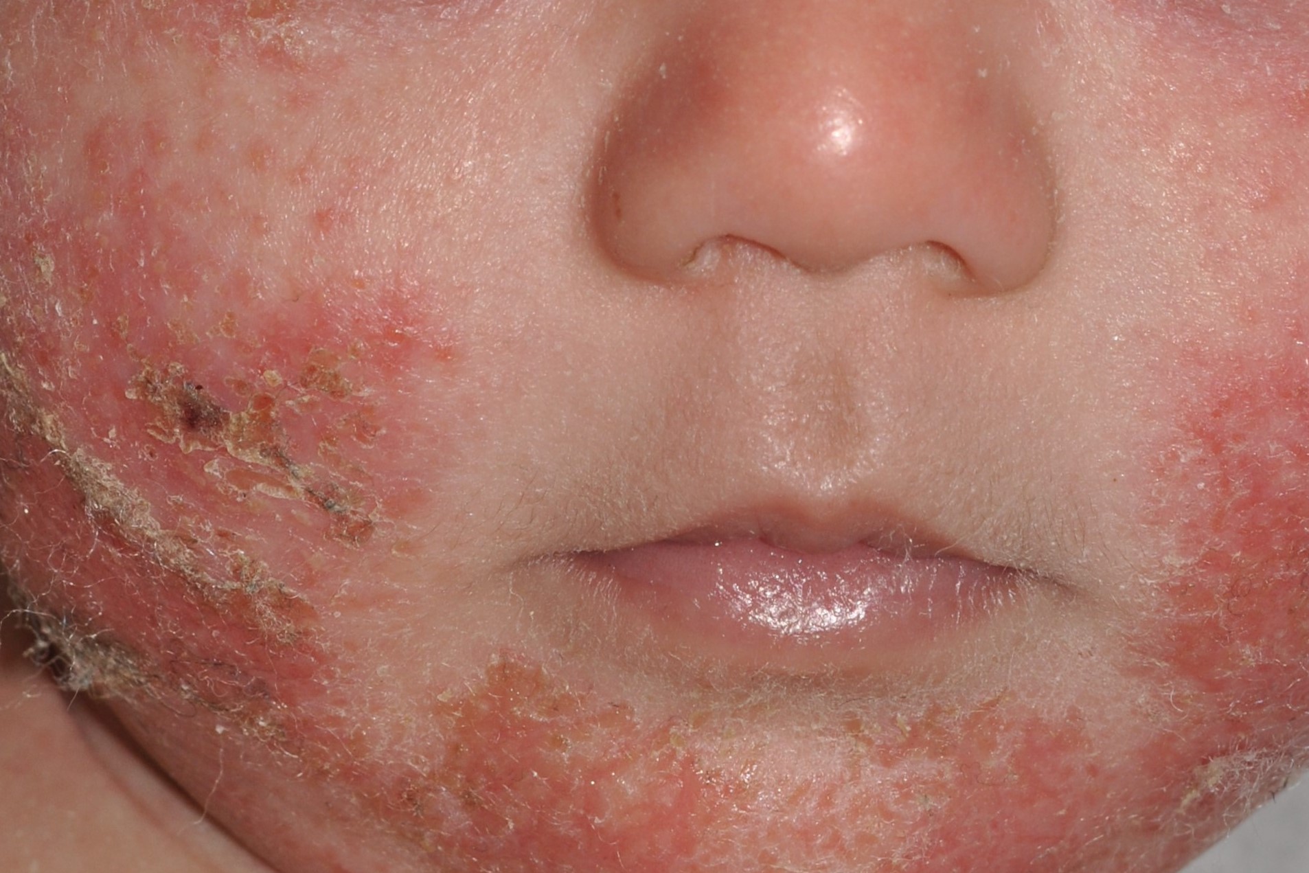 1L20 dermatitis atópica; fase del lactante; eczema subagudo; placas eritematosas con exudación y algunas costras en mejillas (1)