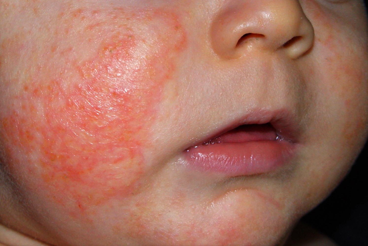 1L20 dermatitis atópica; fase del lactante; eczema subagudo; placas eritematosas con exudación y algunas costras en mejillas (3)