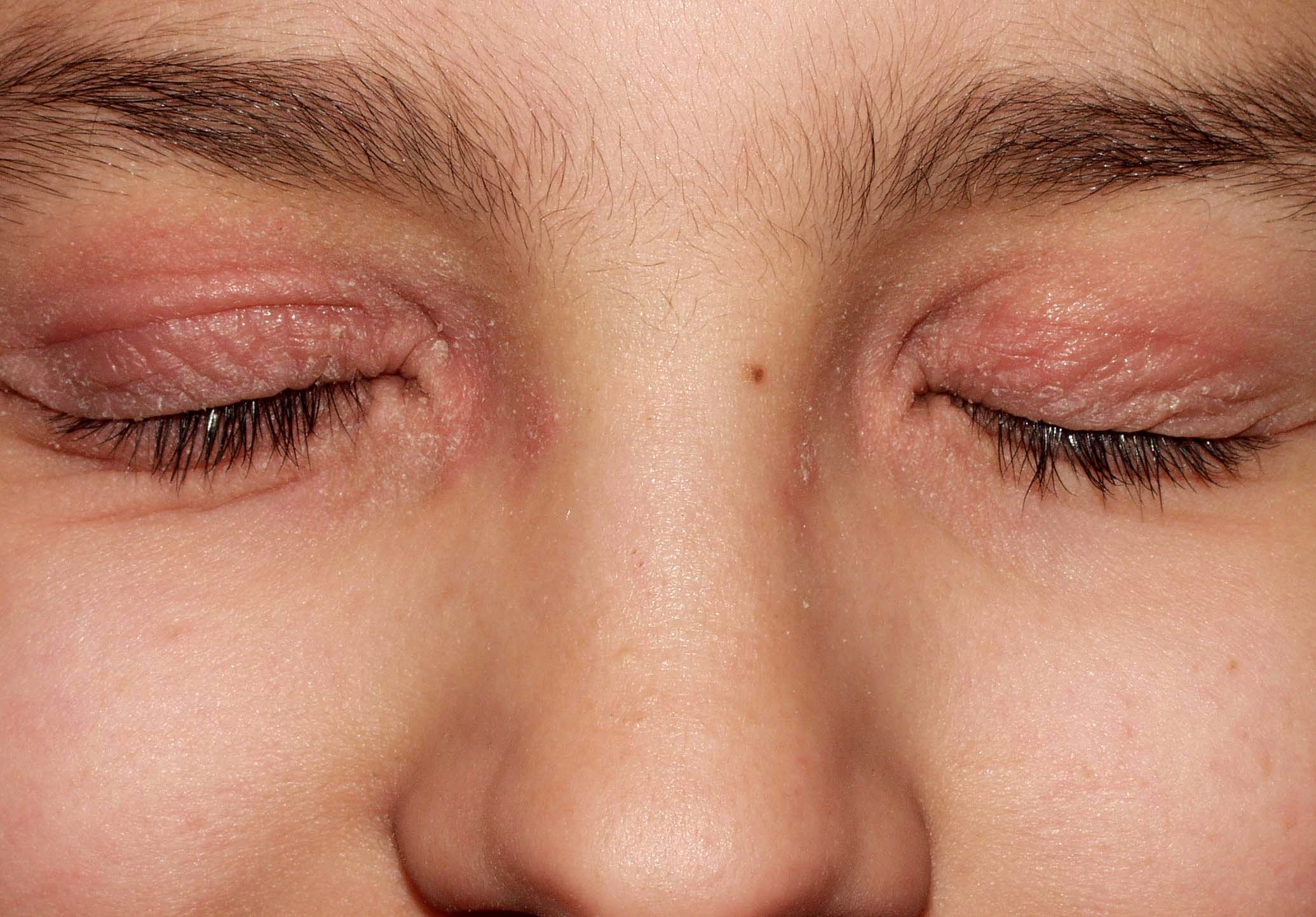 1L20 dermatitis atópica, fase infantil; blefaritis, lesiones eritematodescamativas y pruriginosas de evolución crónica