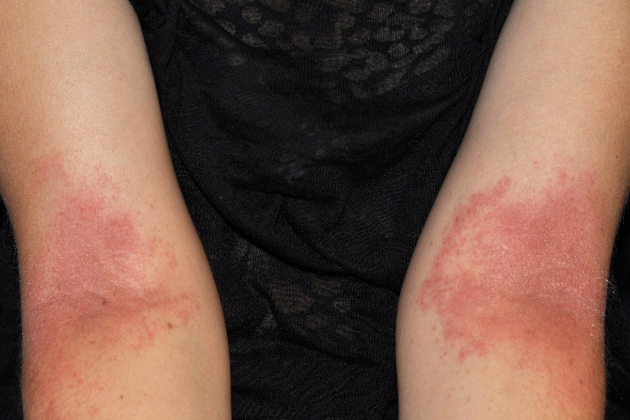 1L20 dermatitis atópica infantil; fase crónica; placas eritematosas, liquenificadas y excoriadas en hueco poplíteo (ver engrosamiento epidérmico y aumento de cuadrícula cutánea (5)