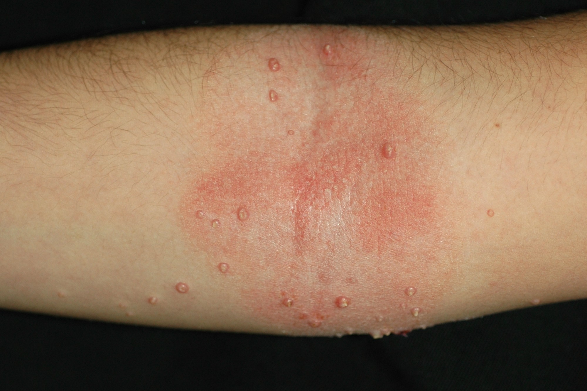 1L20 dermatitis atópica infantil; fase crónica; placas eritematosas, liquenificadas y excoriadas en hueco poplíteo (ver engrosamiento epidérmico y aumento de cuadrícula cutánea (6)