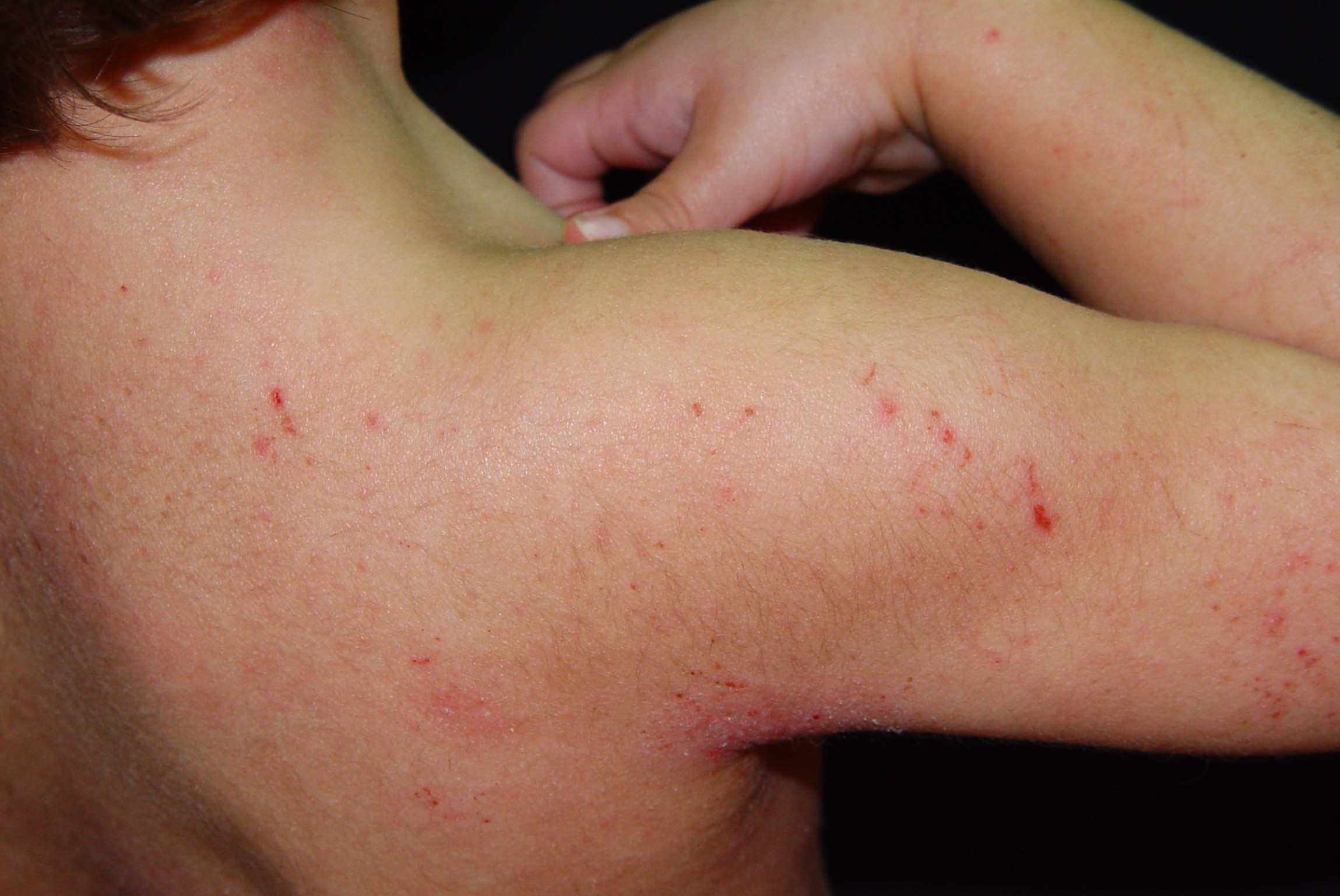 1L20 dermatitis atópica infantil; fase crónica; placas eritematosas, liquenificadas y excoriadas en hueco poplíteo (ver engrosamiento epidérmico y aumento de cuadrícula cutánea (7)