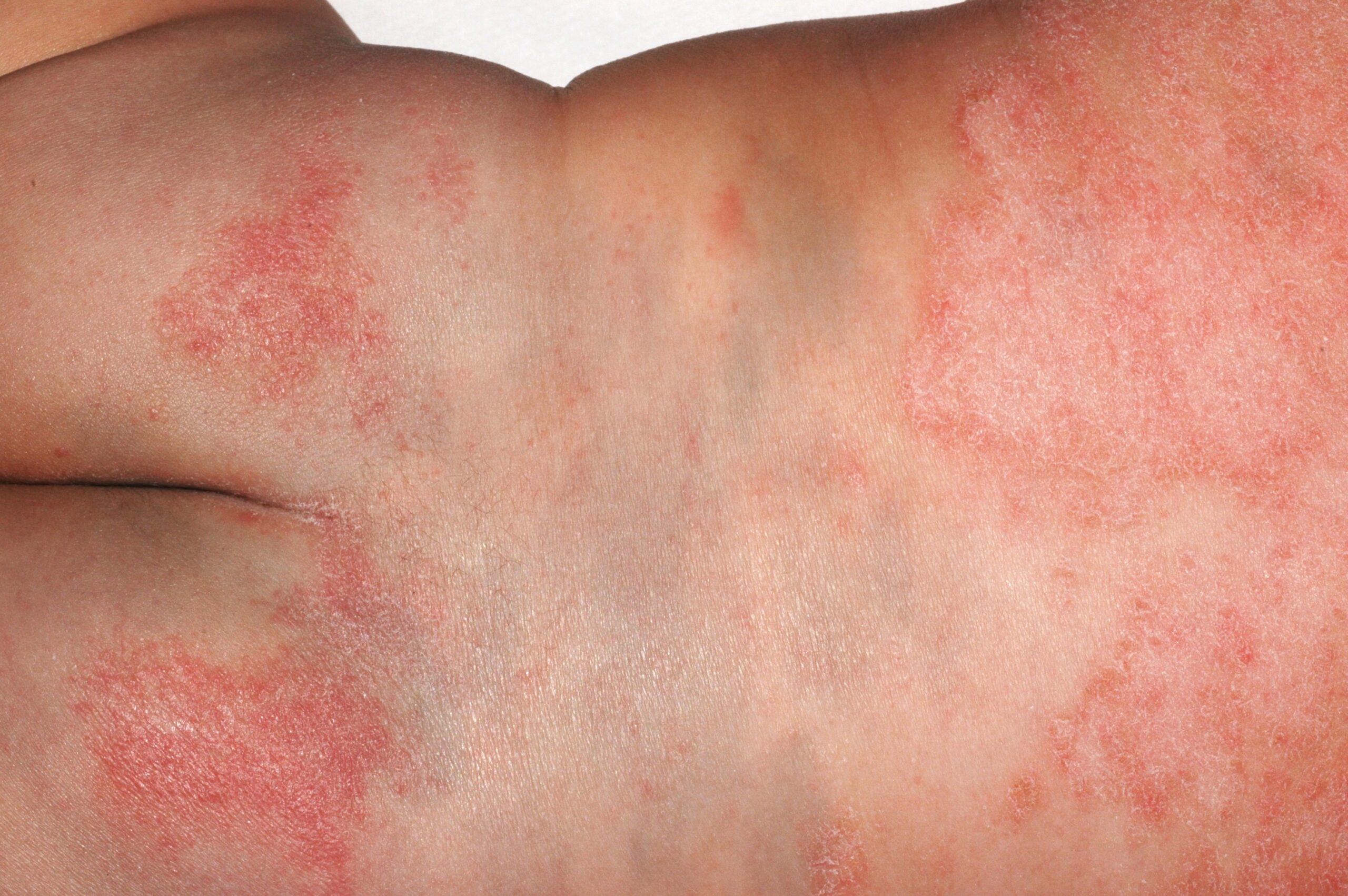 1L20 dermatitis atòpica infantil; placas eritematodescamativas y pruriginosas en tronco