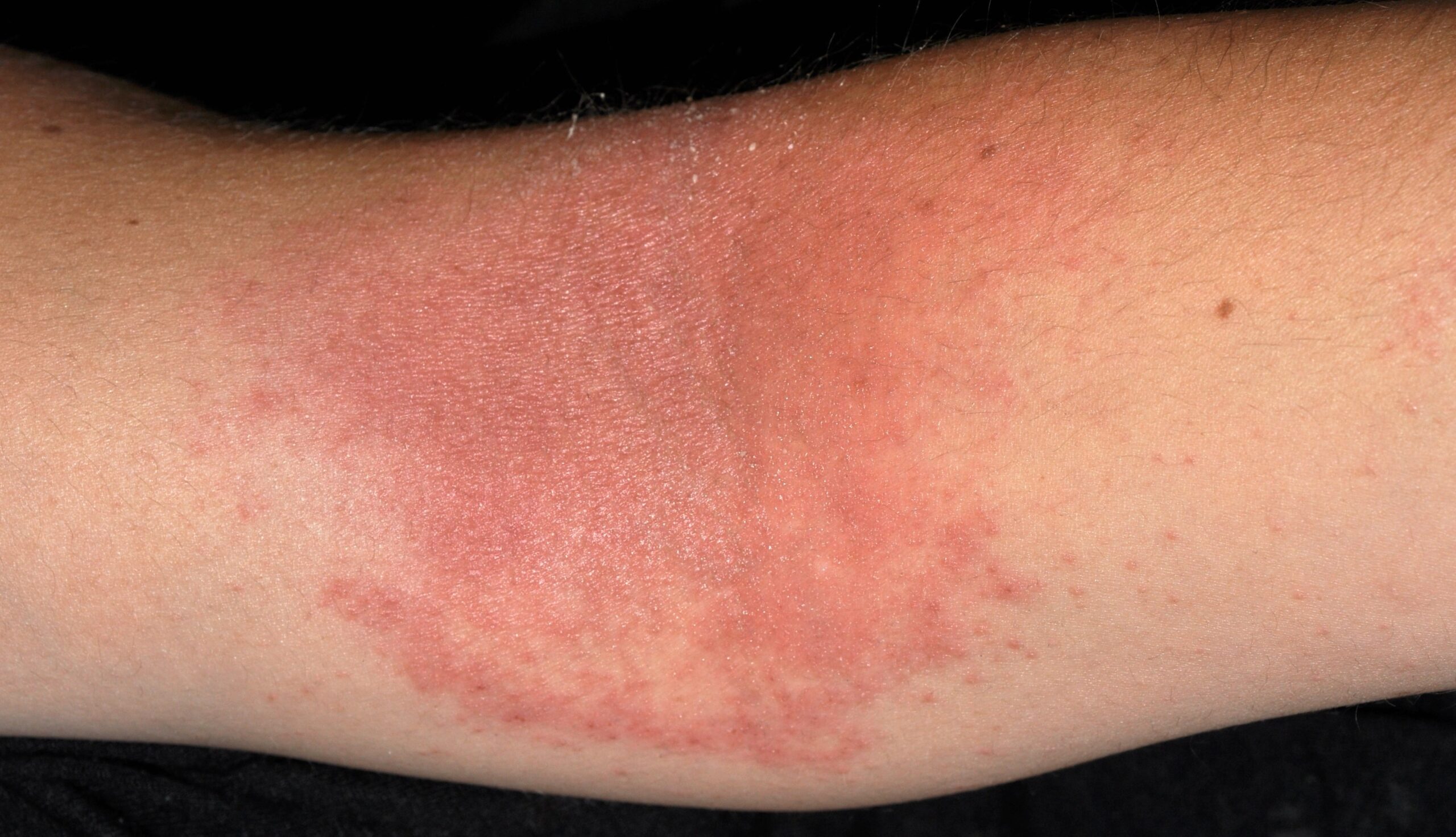 1L20 dermatitis atópica infantil; placas eritematoexudativas y costrosas pliegue antecubital1 (3)