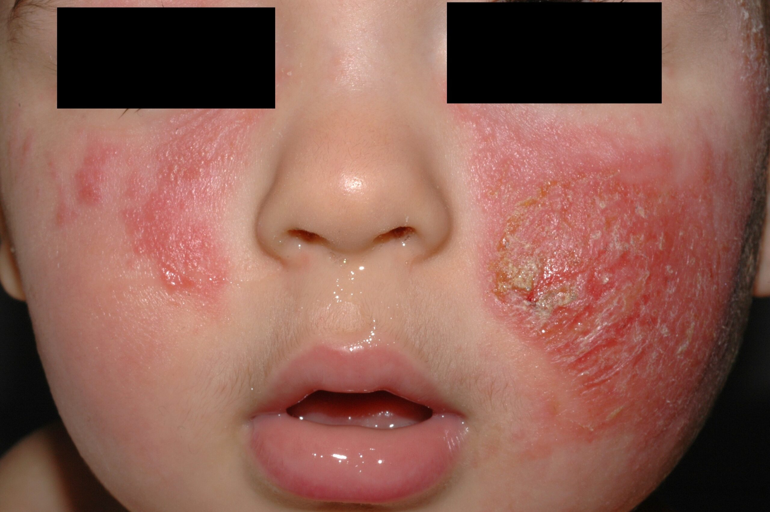 1L20 dermatitis atopica; placas eritematoescamosas; exudativas; distribución cara y grandes pliegues; erupción; localización cara; evolución 6 meses (2)