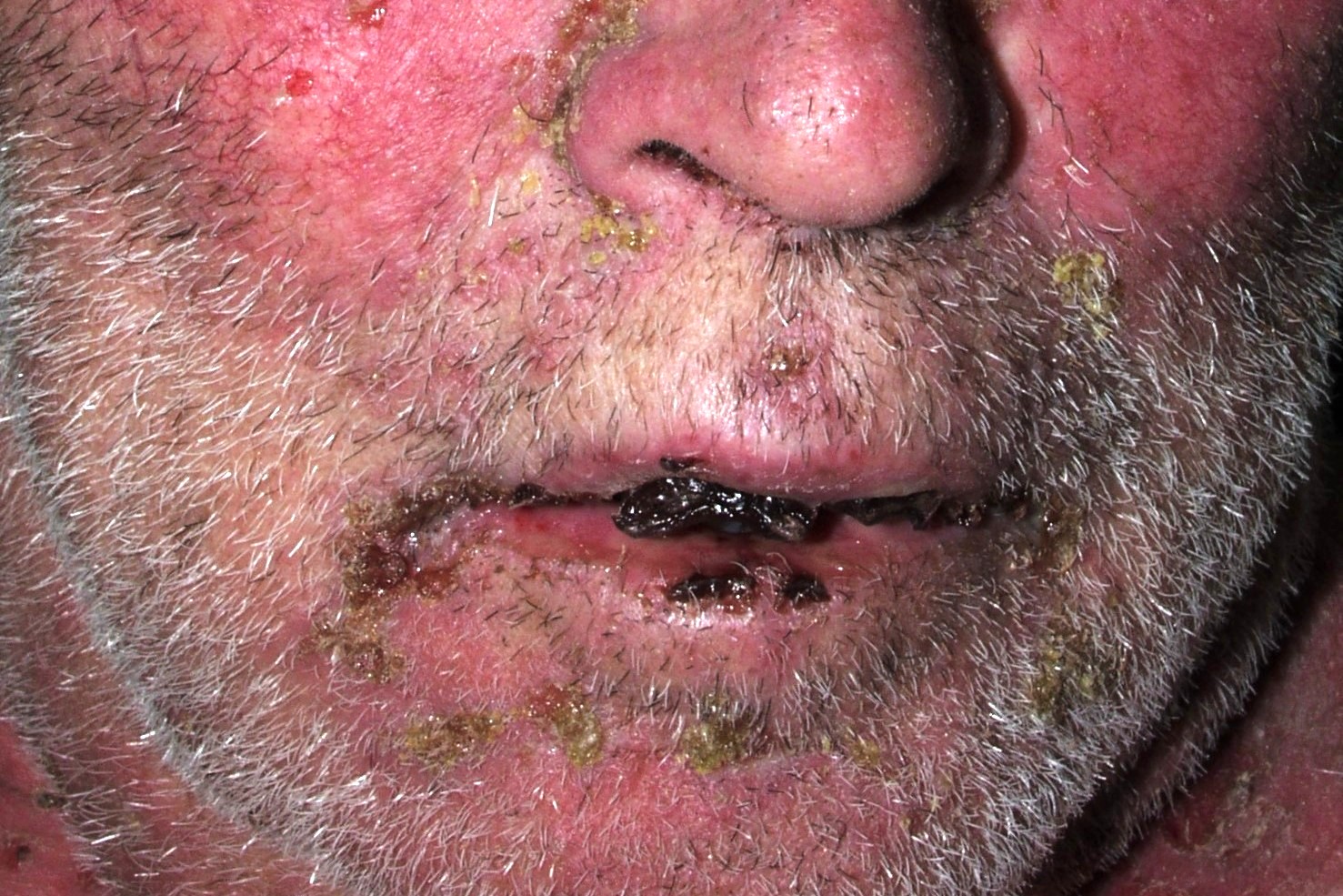 1Necrolisis epidermica t&oacute;xica L51.2; s&iacute;ndrome de Lyell; eritema facial y generalizado, erosiones y costras en mucosa oral
