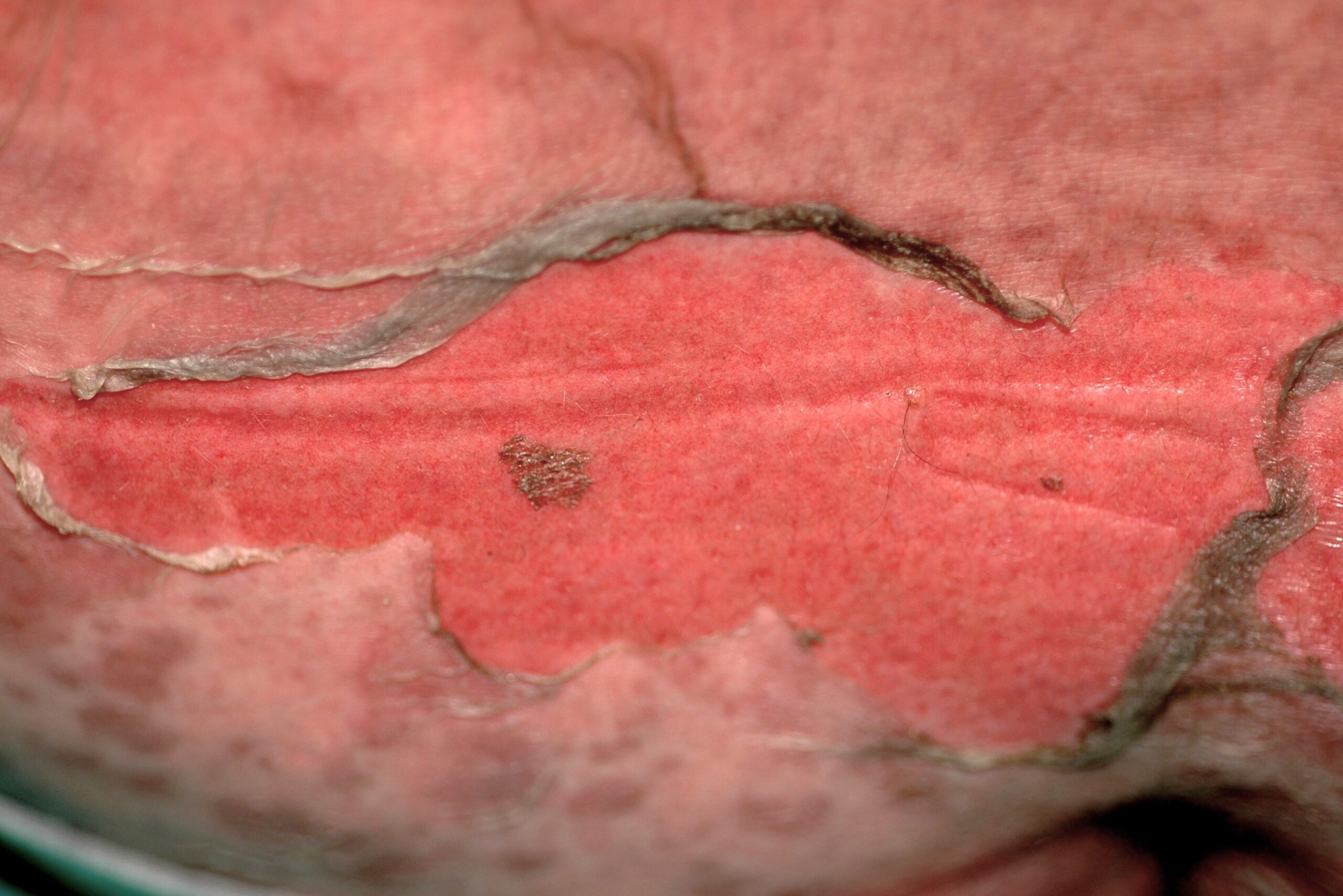 1Necrolisis epidermica t&oacute;xica L51.2; s&iacute;ndrome de Lyell; erosiones por despegamiento epitelial en s&aacute;bana que afectan m&aacute;s del 30% de la superficie corporal