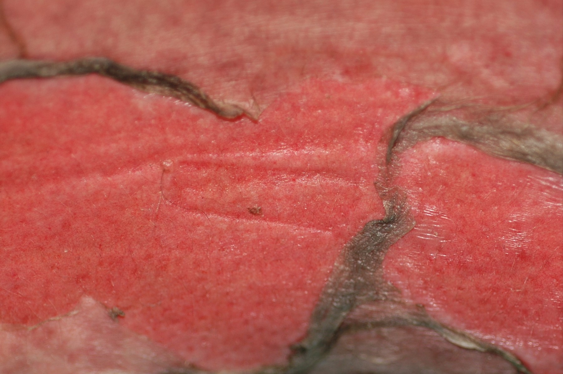 1Necrolisis epidermica t&oacute;xica L51.2; s&iacute;ndrome de Lyell; m&aacute;culas eritematosas y erosiones; localizaci&oacute;n generalizada (5)