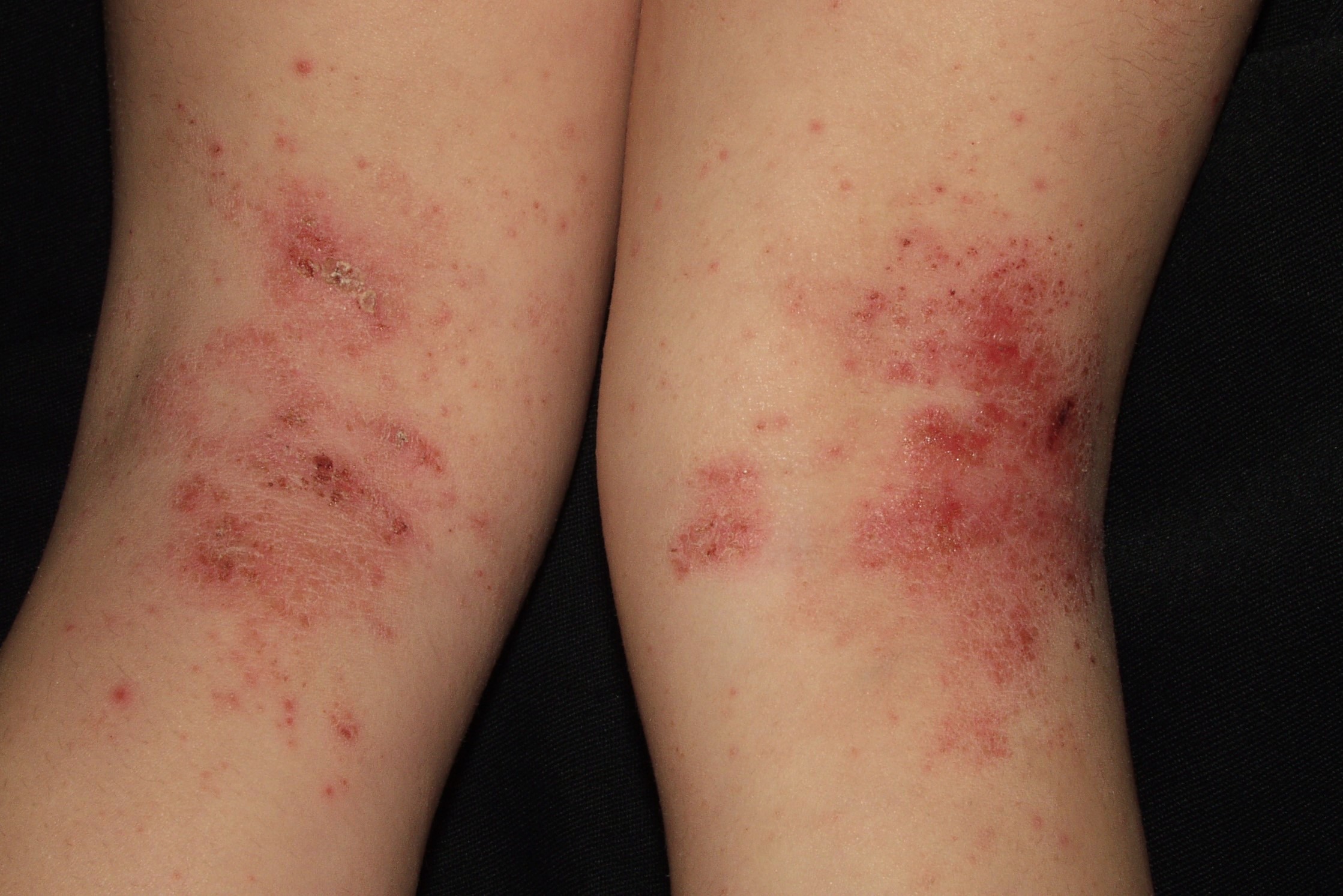 1dermatitis atópica infantil L20; eczema subagudo; placas eritematosas, liquenificadas, erosionadas y excoriadas en huecos poplíteos
