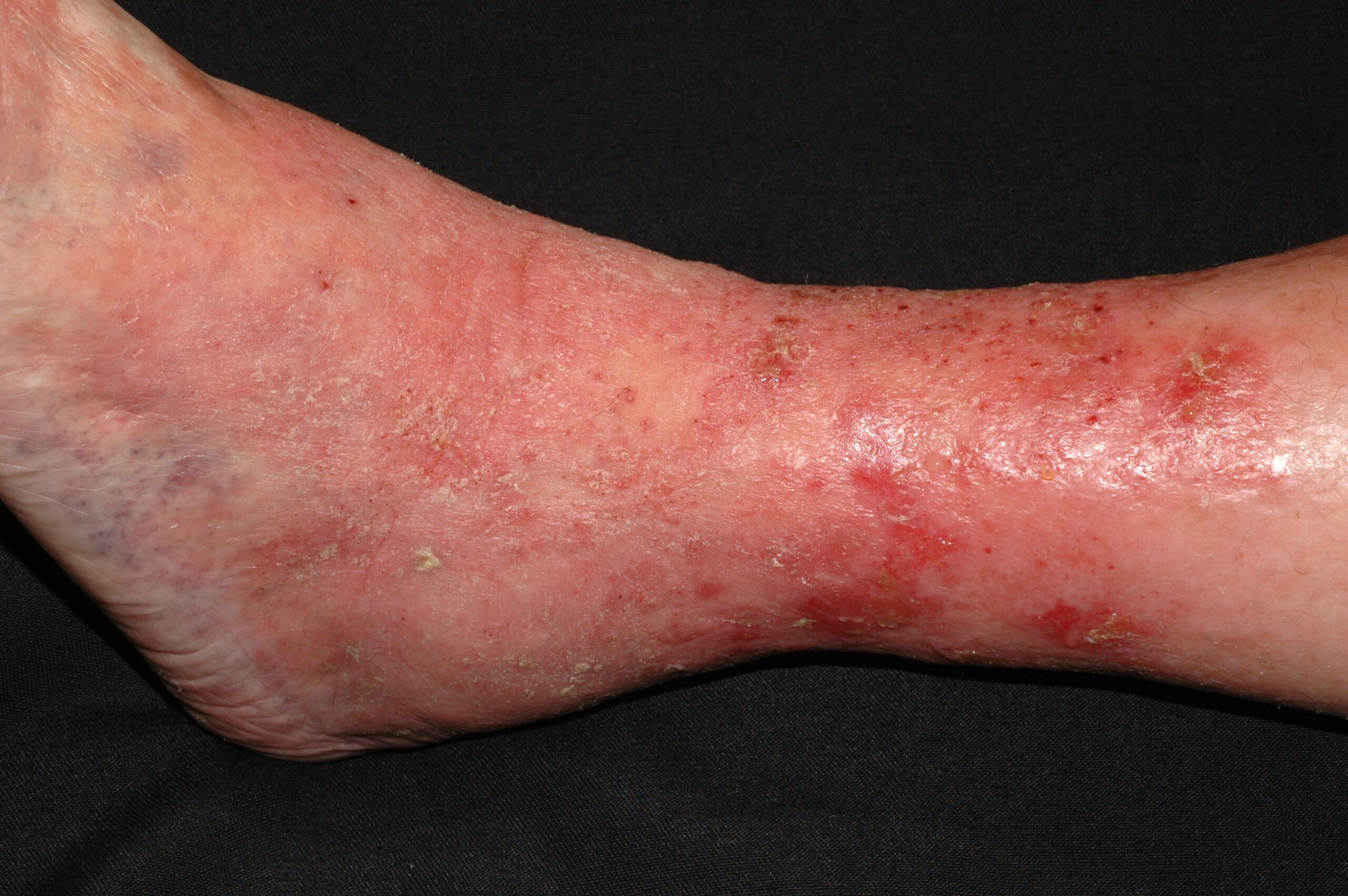 Dermatitis de estasis I87.21; eczema varicoso; placas eritematosas, exudativas, con erosiones y descamación (1)