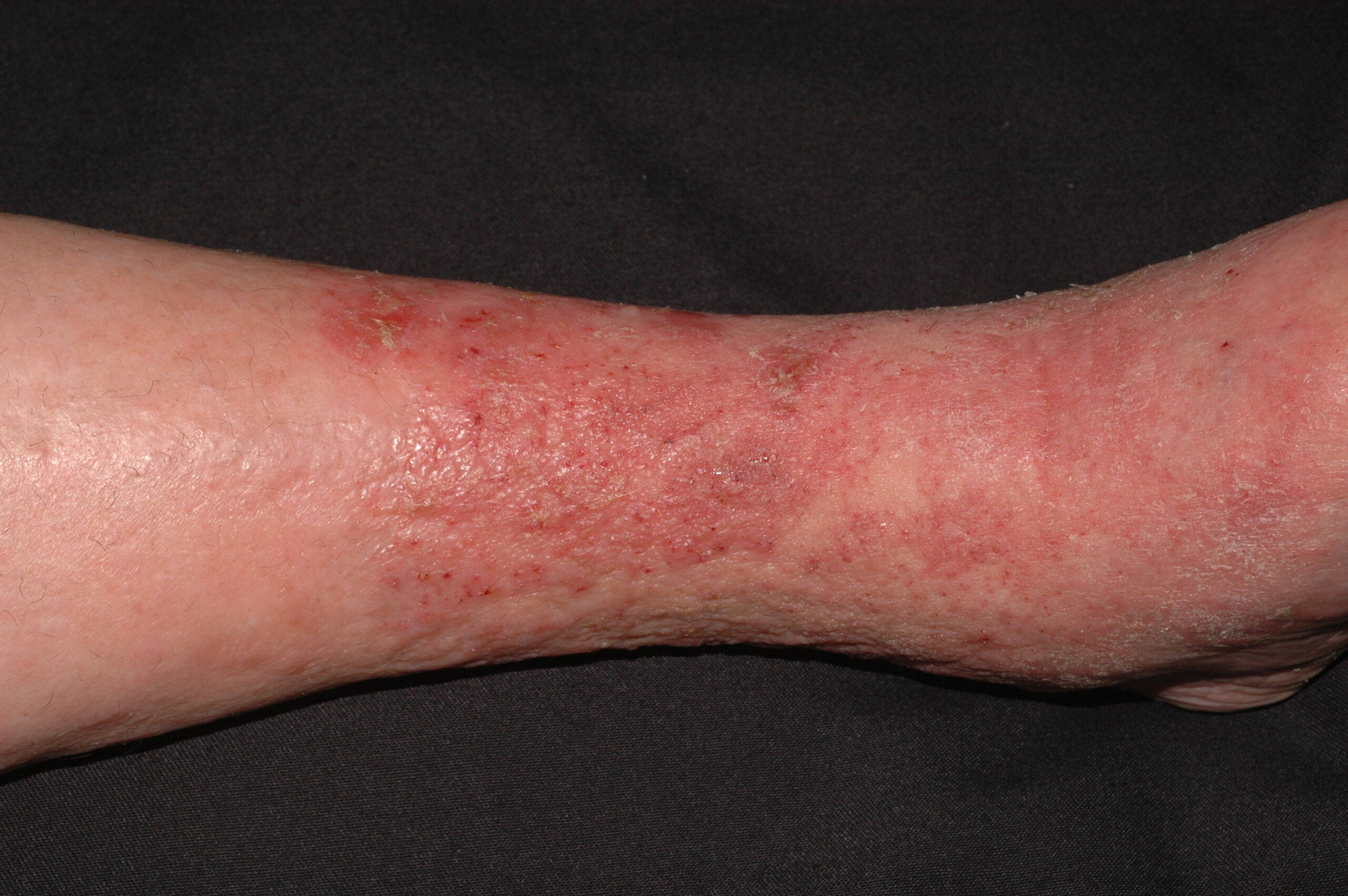 Dermatitis de estasis I87.21; eczema varicoso; placas eritematosas, exudativas, con erosiones y descamación (2)