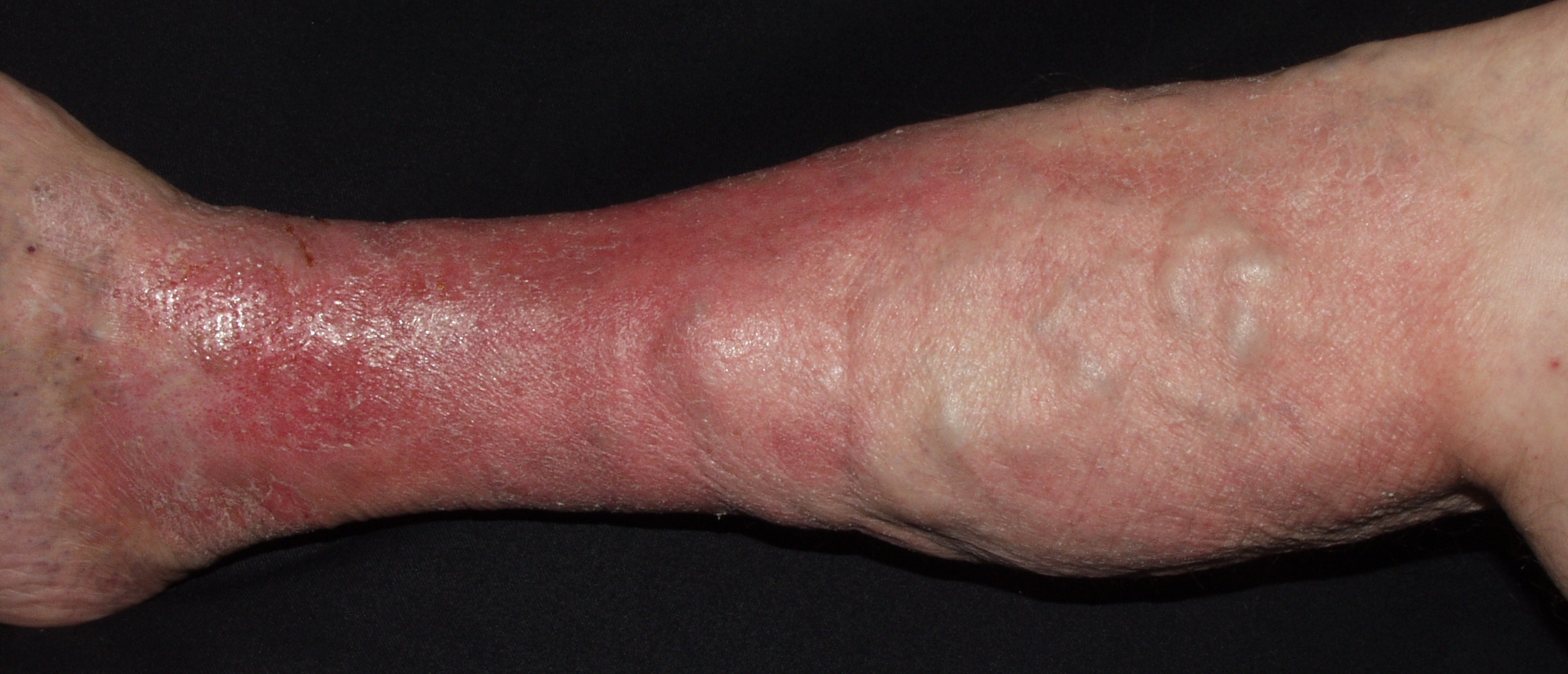 Dermatitis de estasis I87.21; eczema varicoso; placas eritematosas, exudativas, con erosiones y descamación1 (2)