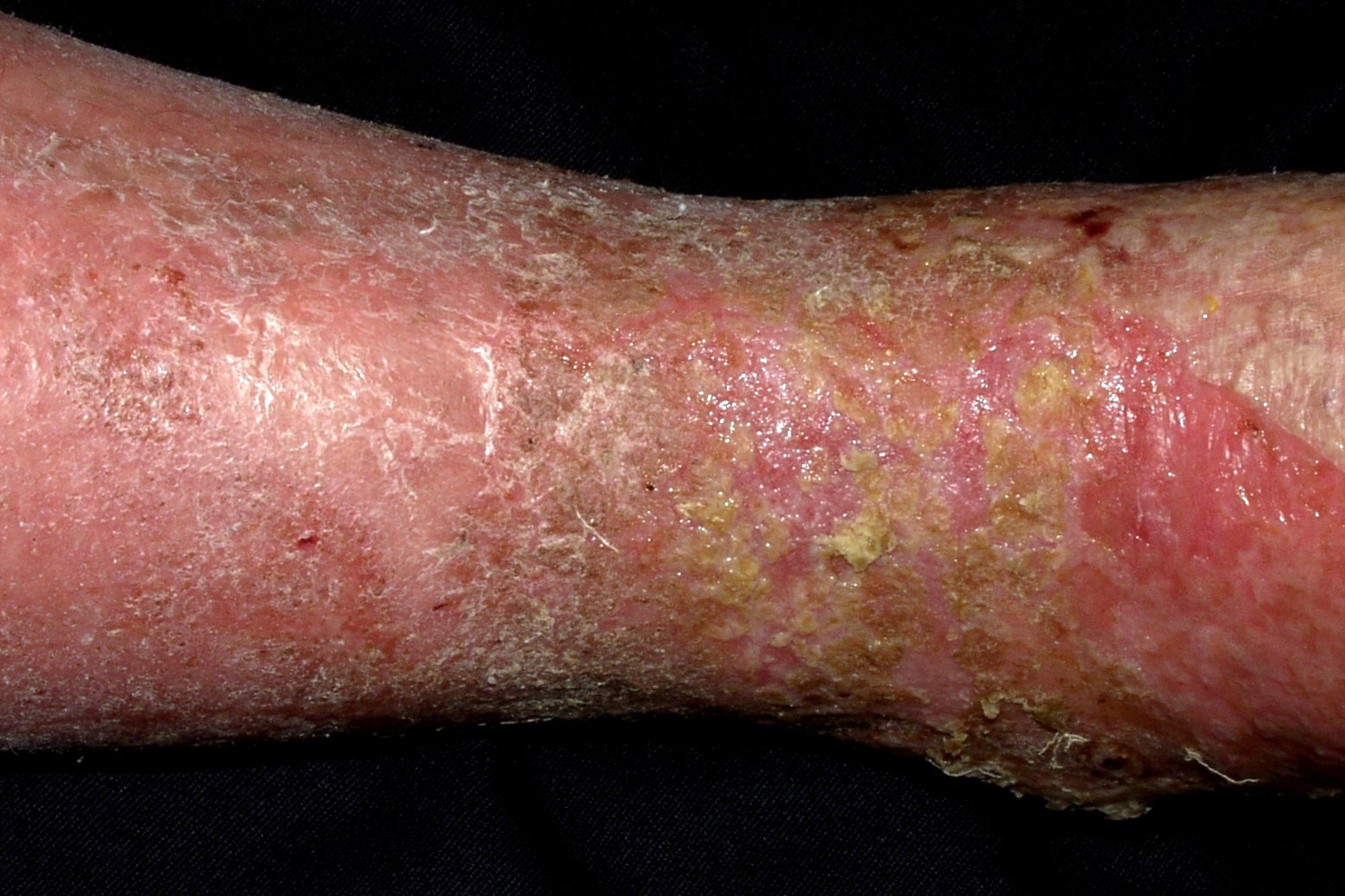 Dermatitis de estasis sobreinfectada I87.21; eczema varicoso sobreinfectado; placas eritematosas, exudativas, con erosiones, descamación y escamocostras amarillentas