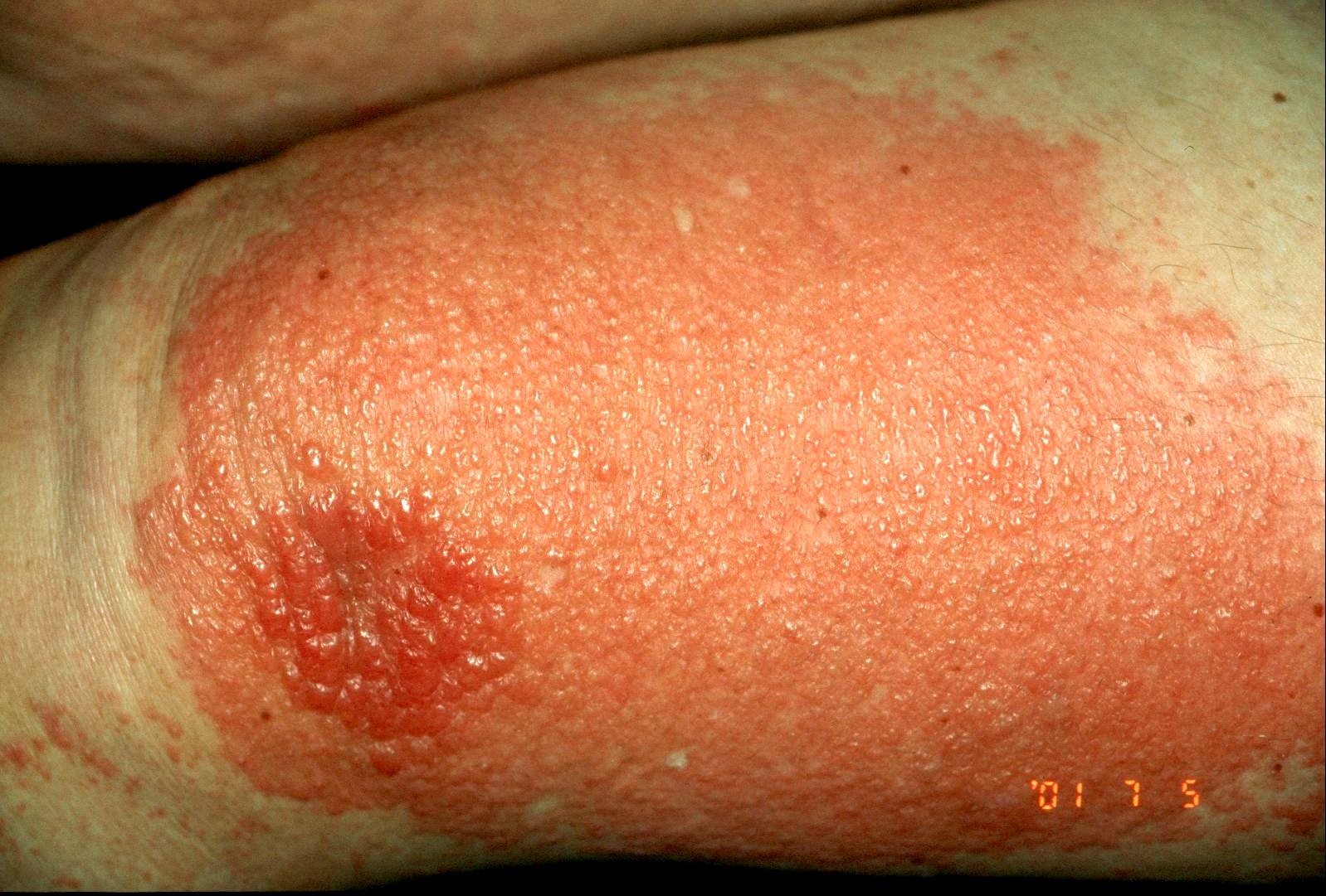 Dermatitis fotoalérgica aguda L56.1; placa intesamente eritematosa con cientos de vesículas tras aplicarse la crema de piroxicam y exponerse al sol