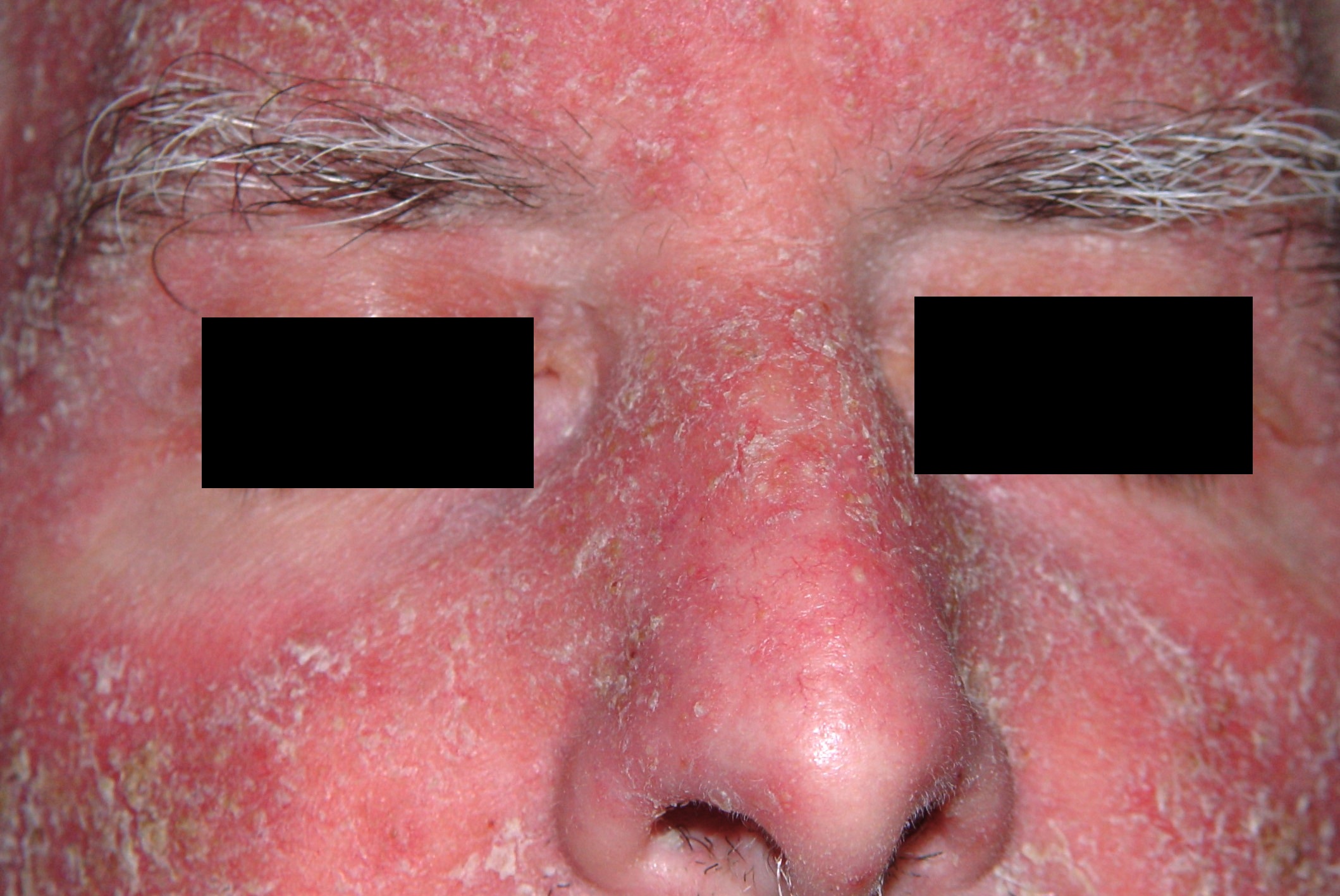 Dermatitis fotoalérgica por la ingesta de AINEs L56.1; eritema intenso con descamación y prurito al cabo de unos días de tomar ketoprofeno
