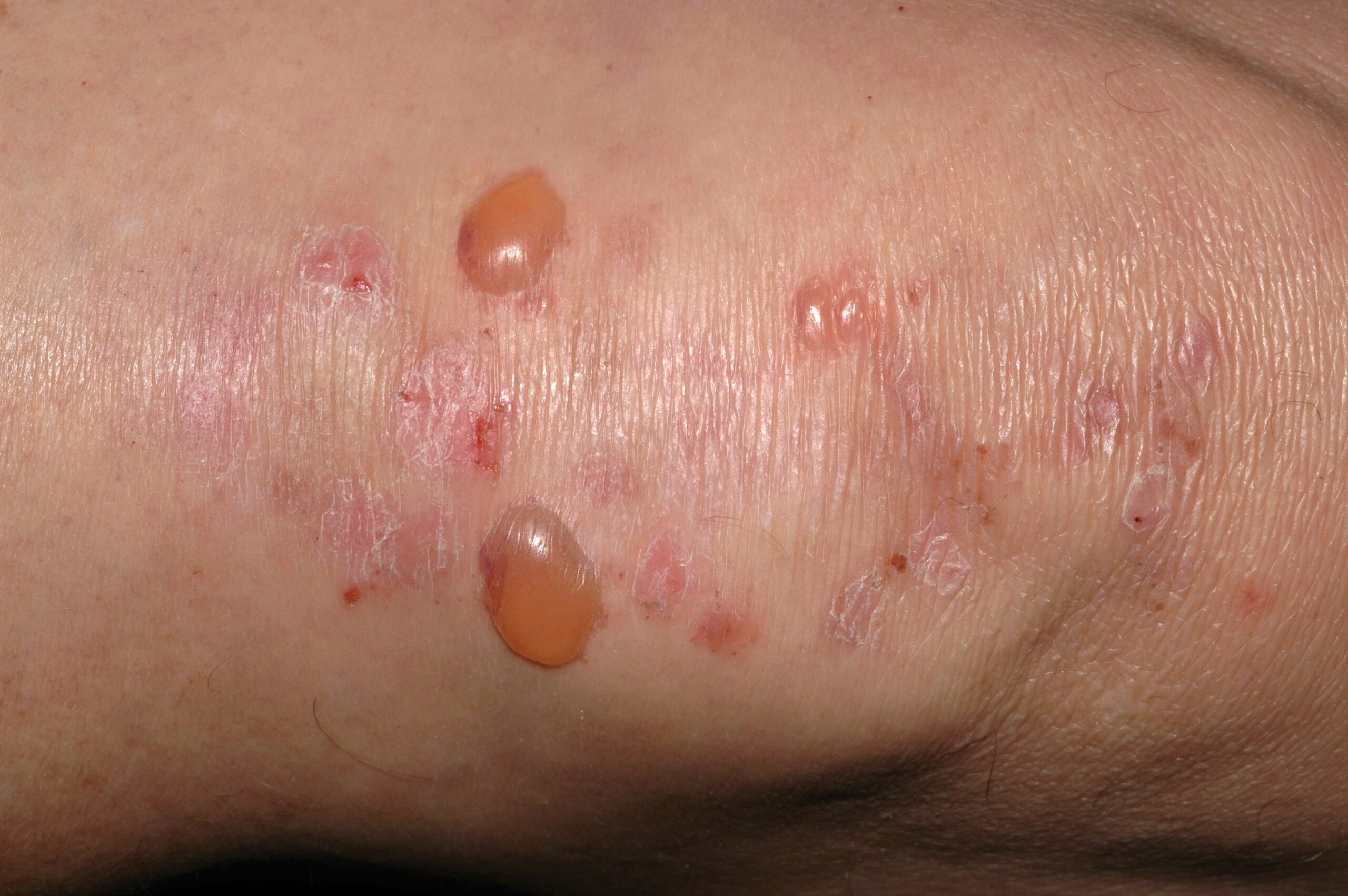 Dermatitis herpetiforme L13.0; ampollas peque&ntilde;as a tensi&oacute;n y costras en las rodillas (1)