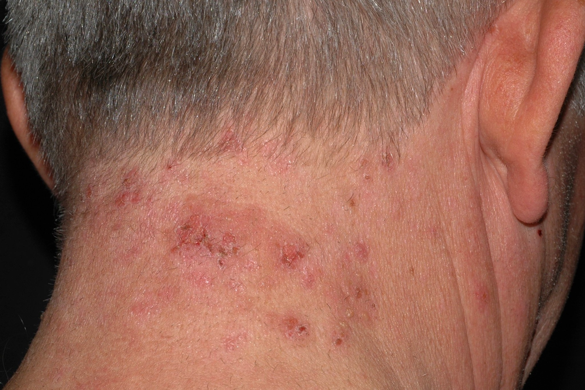 Dermatitis herpetiforme L13.0; placas eritematosas, ves&iacute;culas pruriginosas y costras en cara posterior del cuello (1)