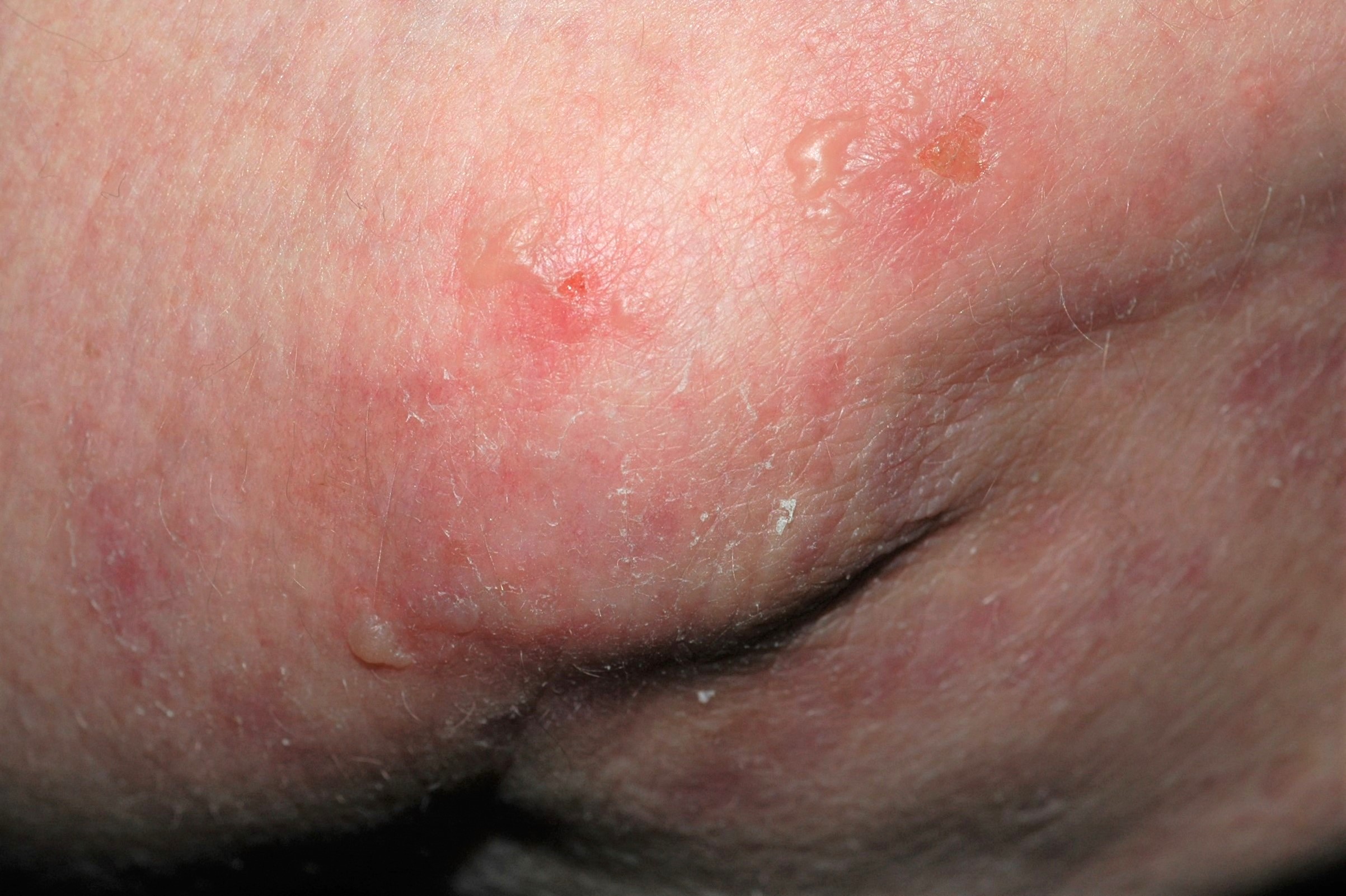Dermatitis herpetiforme L13.0; ves&iacute;culas intensamente pruriginosas en los codos (1)