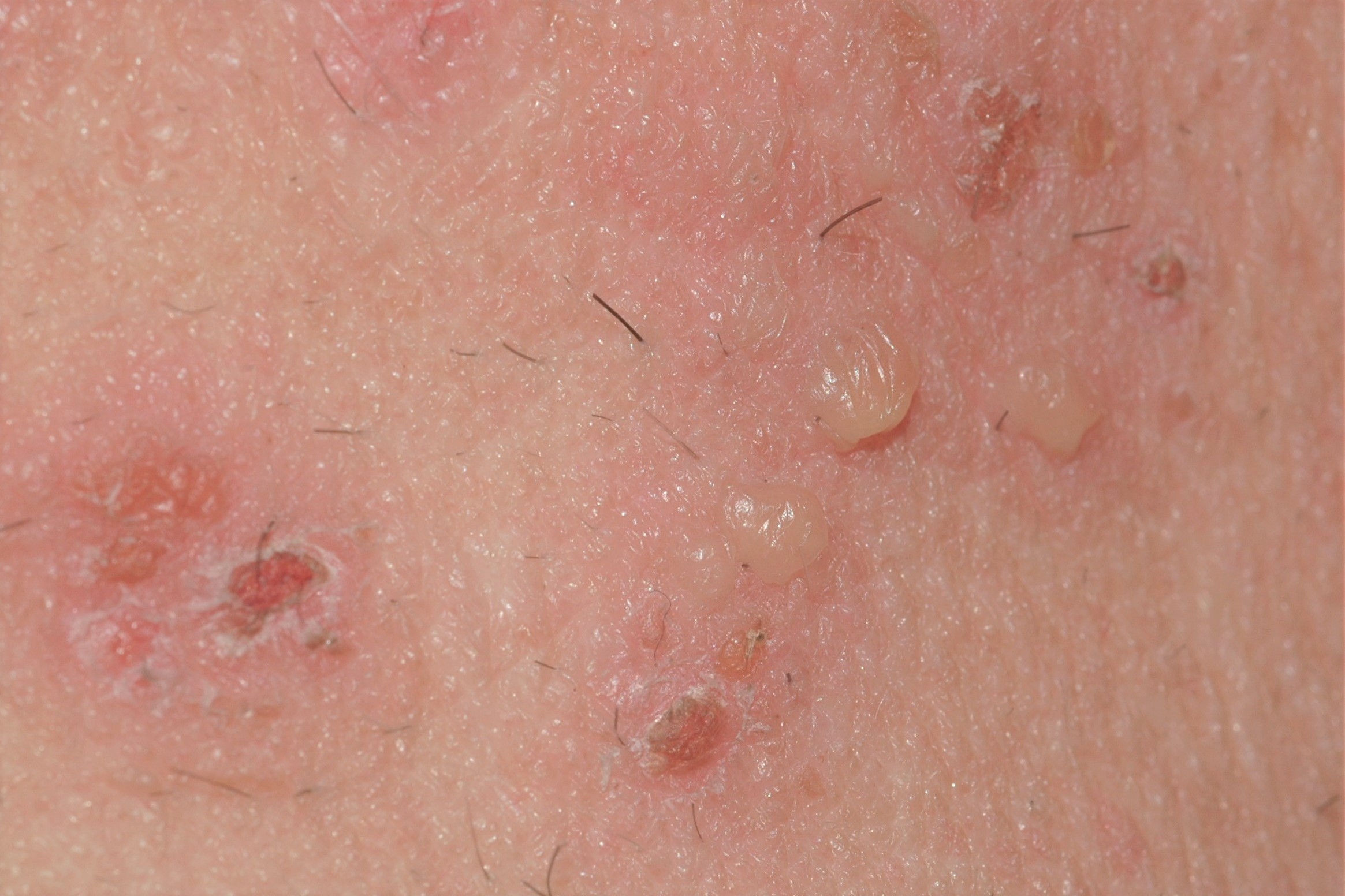 Dermatitis herpetiforme L13.0; ves&iacute;culas pruriginosas y costras en la parte superior de la espalda