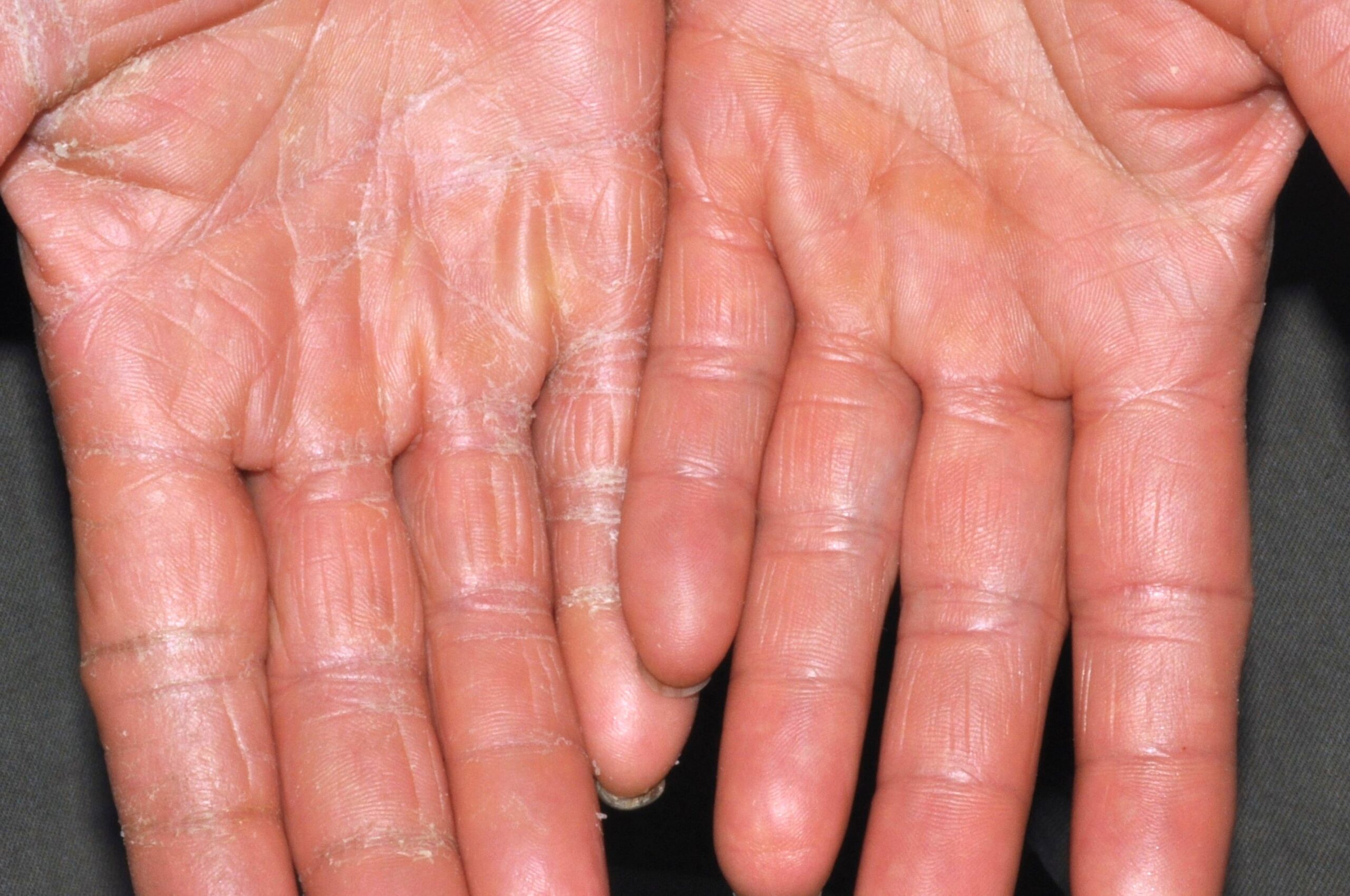 Dermatitis irritativa de contacto L24; manos secas con discreto eritema y descamación. Palmas hiperlineales