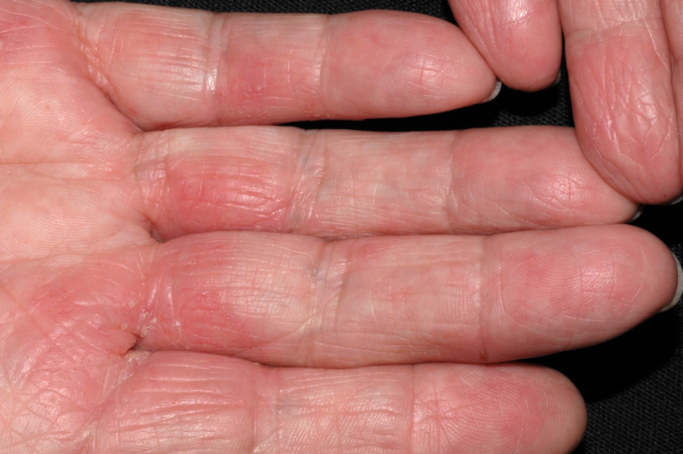 Dermatitis irritativa de contacto L24; manos secas con eritema, descamación y  aumento de las líneas de las palmas