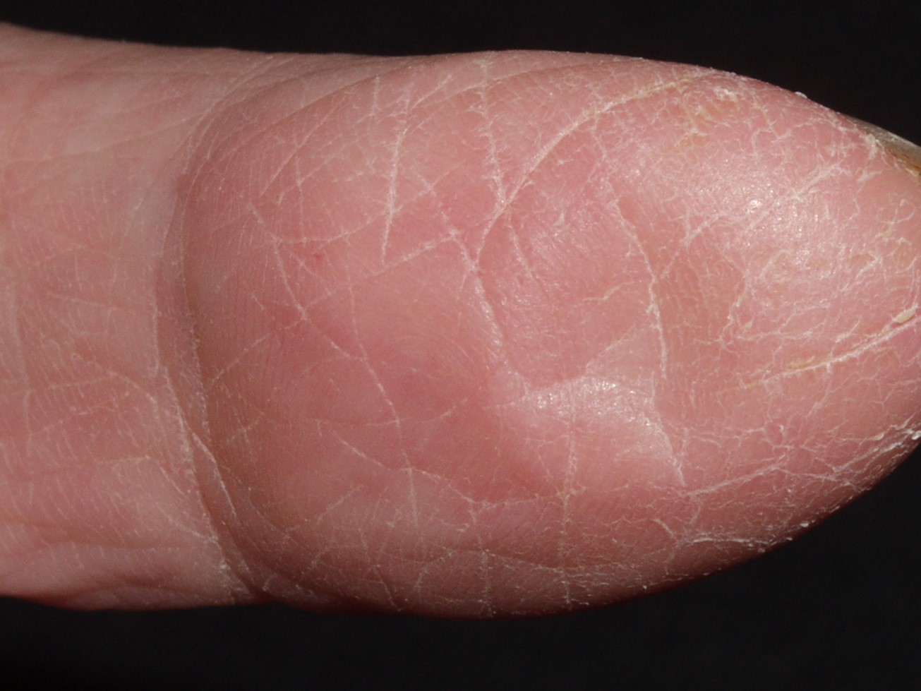 Dermatitis irritativa de contacto L24; pulpitis descamativa. Signo de la pelota de ping-pong
