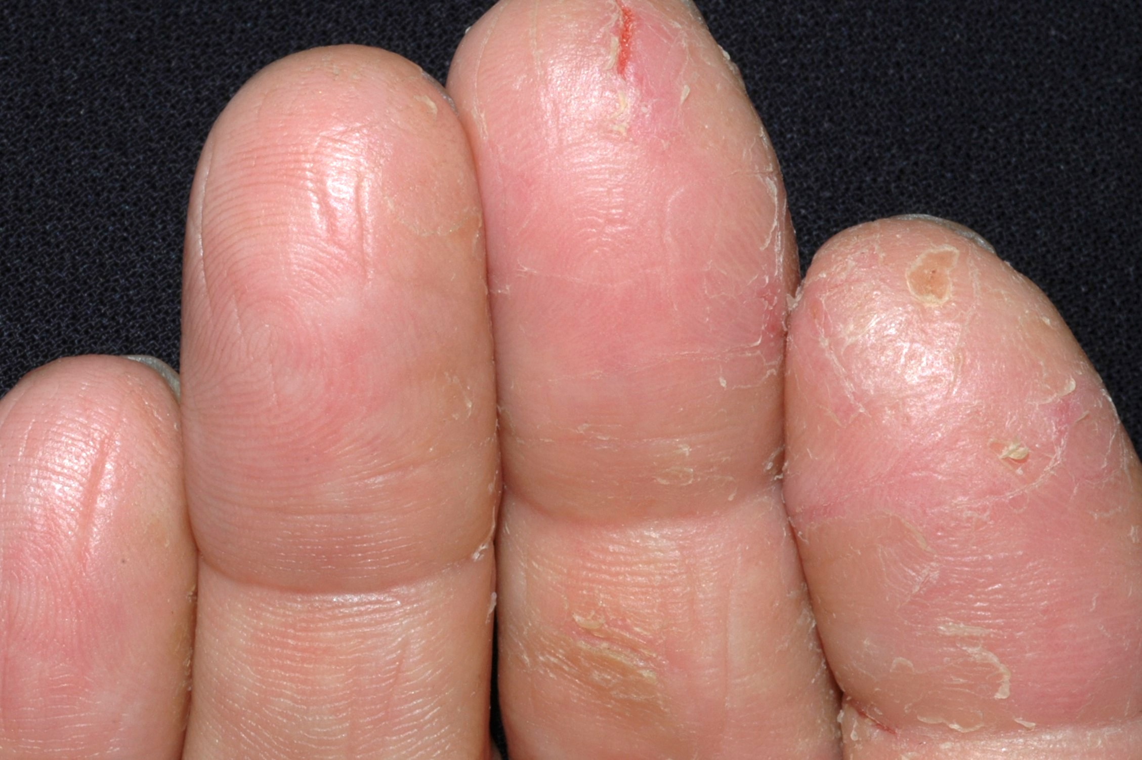 Dermatitis irritativa de contacto L24; pulpitis fisurada y descamativa con pérdida de los dermatoglifos