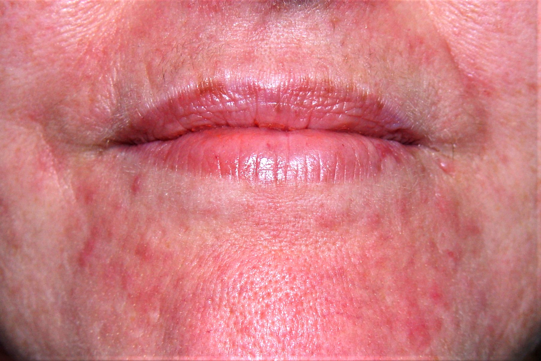 Dermatitis irritativa de contacto L24.0. Dermatitis perioral por cosméticos. Micropápulas y pústulas periorales