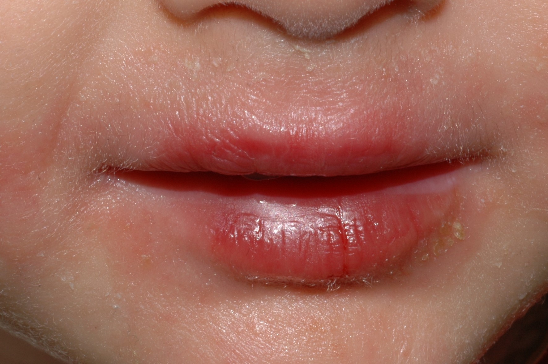 Dermatitis irritativa de contacto L24.9; dermatitis perioral por el chupete y la saliva (3)