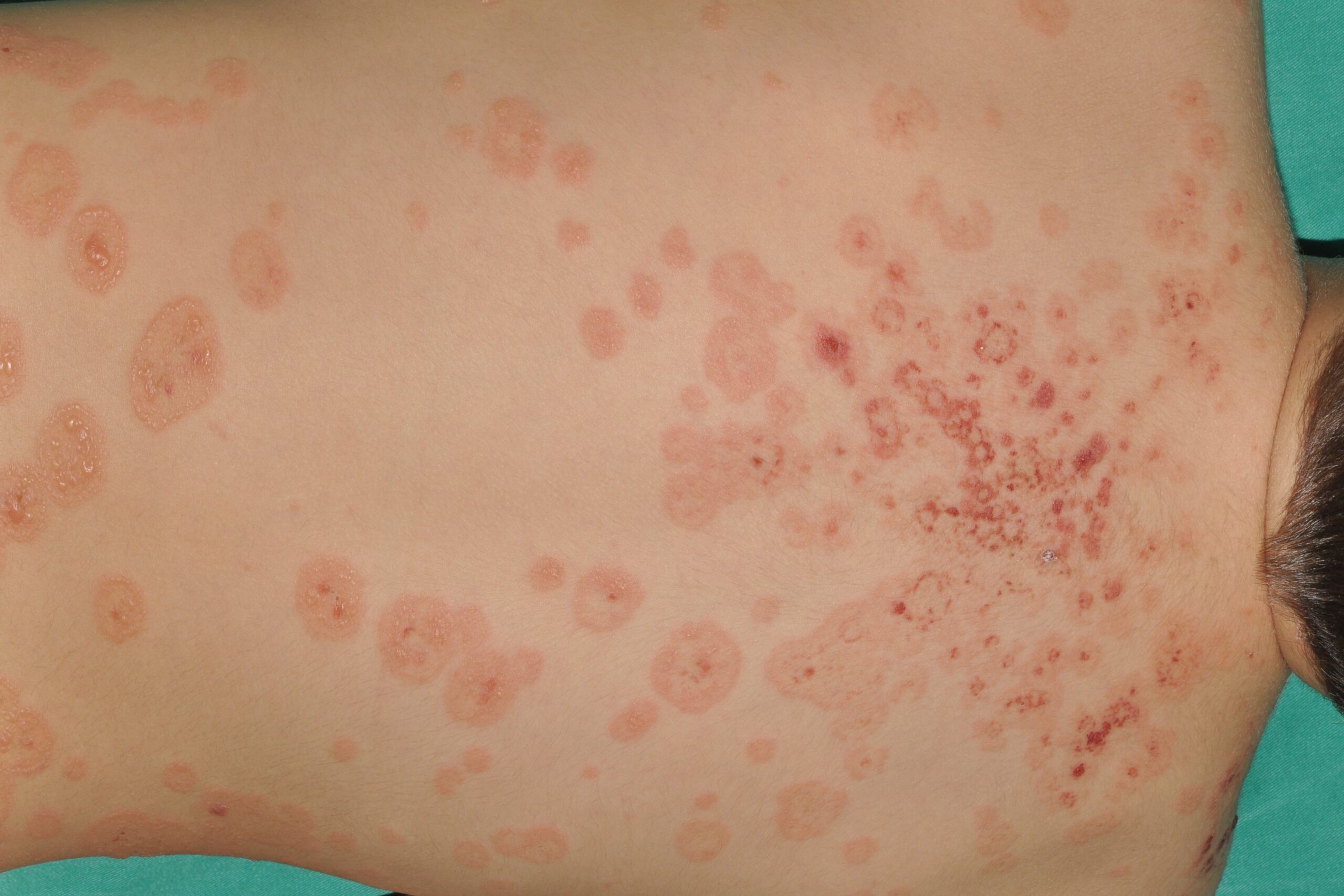 Dermatosis ampollosa cr&oacute;nica benigna infantil (DACBI) L13.8; lesiones ampollosas dispuestas en forma de rosetas, sobre piel normal y eritematosa (15)